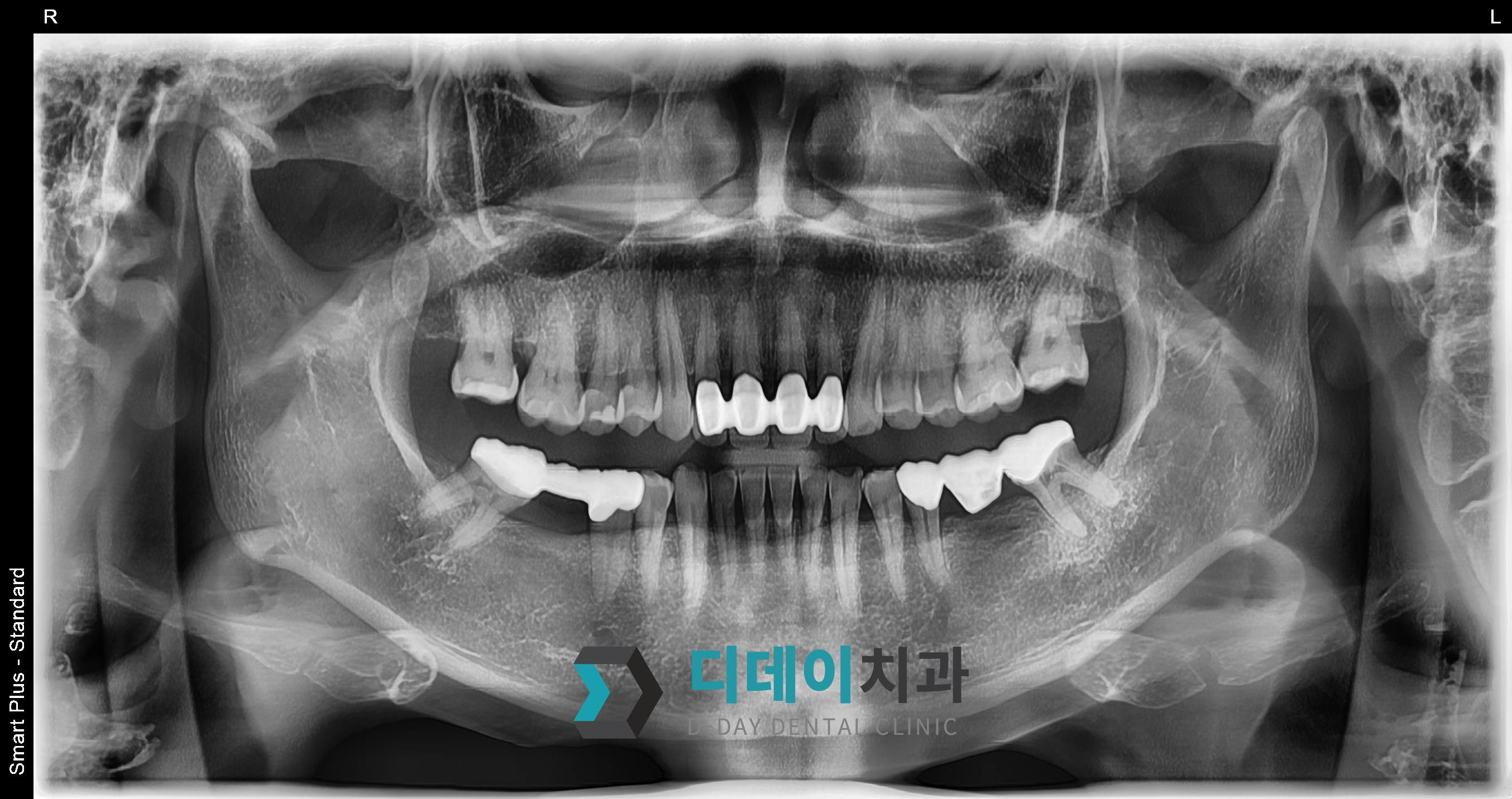 임플란트 (브릿지 제거) 치료 전
