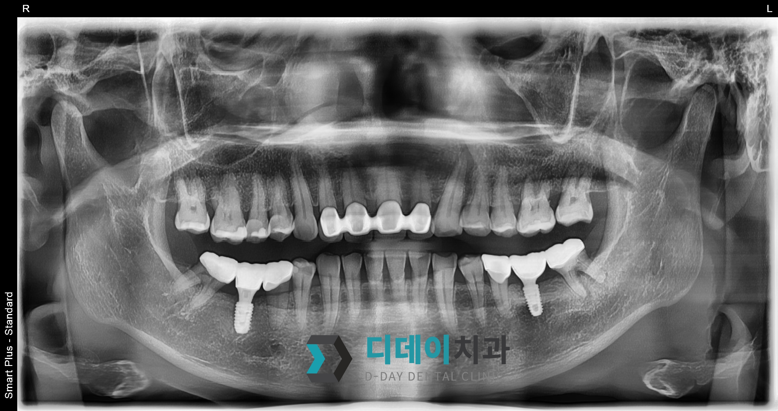 임플란트 (브릿지 제거) 치료 후