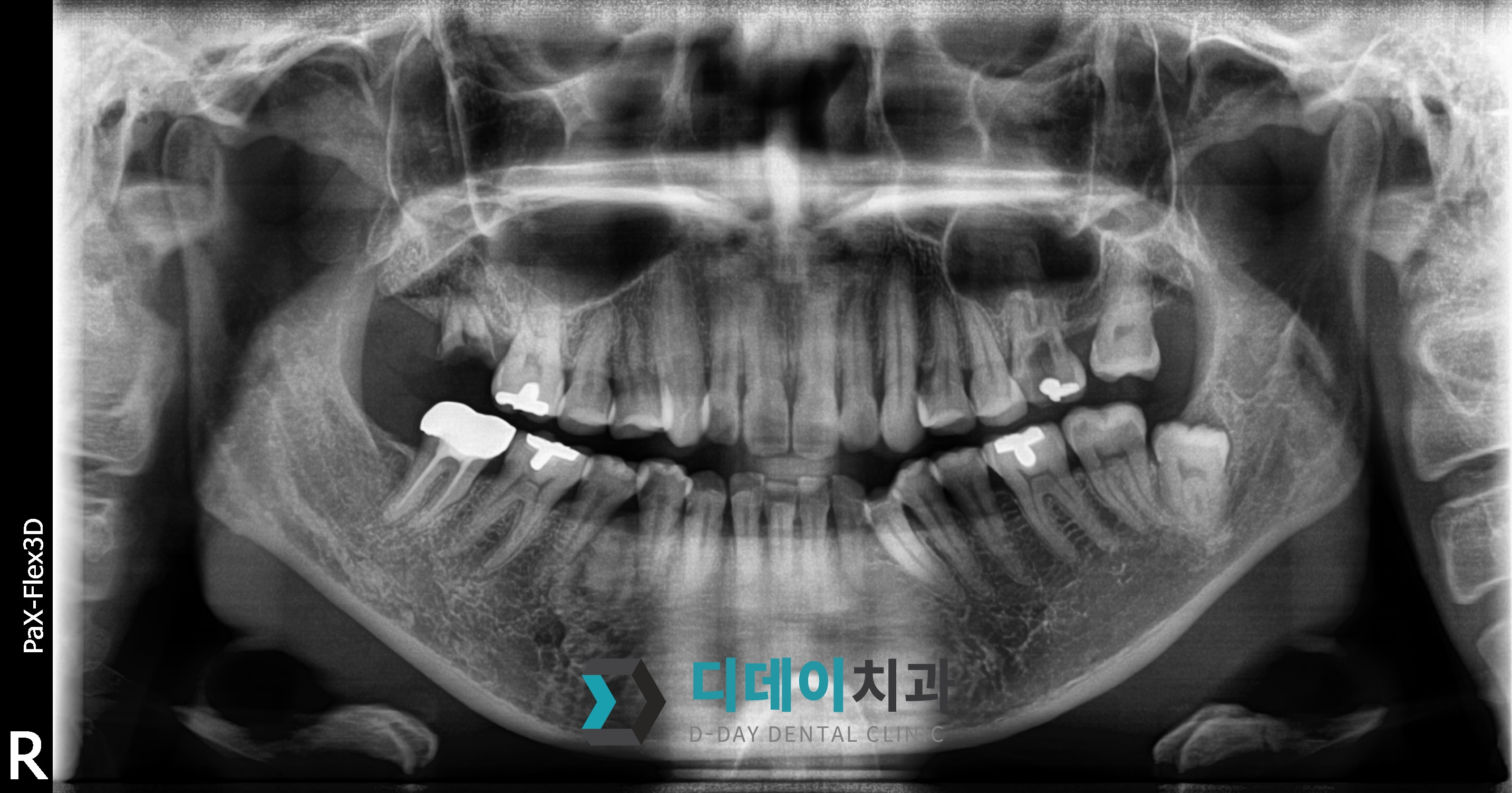 임플란트 (발치후 지연식립) 치료 전