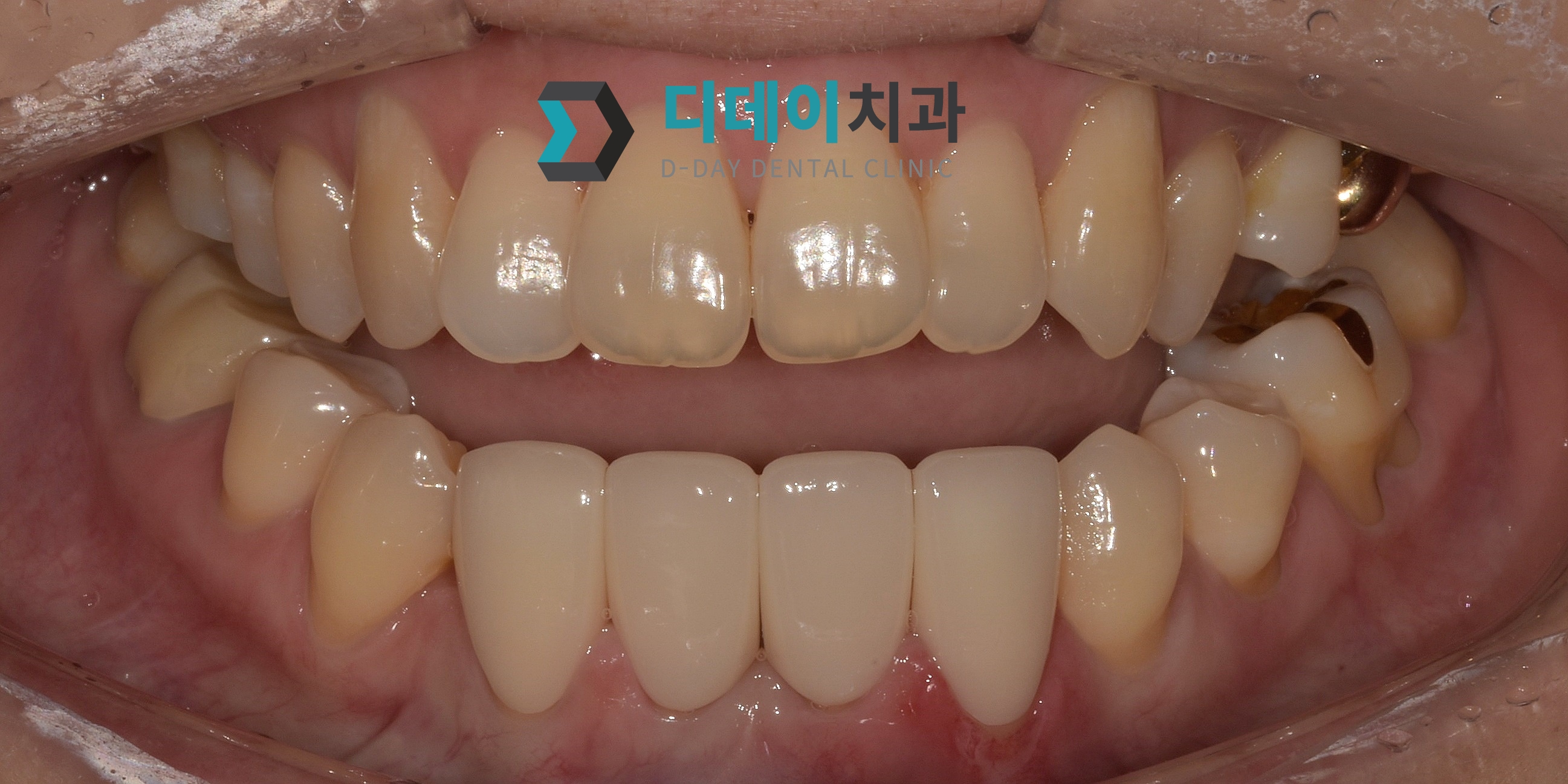 심미보철치료 (지르코니아 크라운) 치료 후