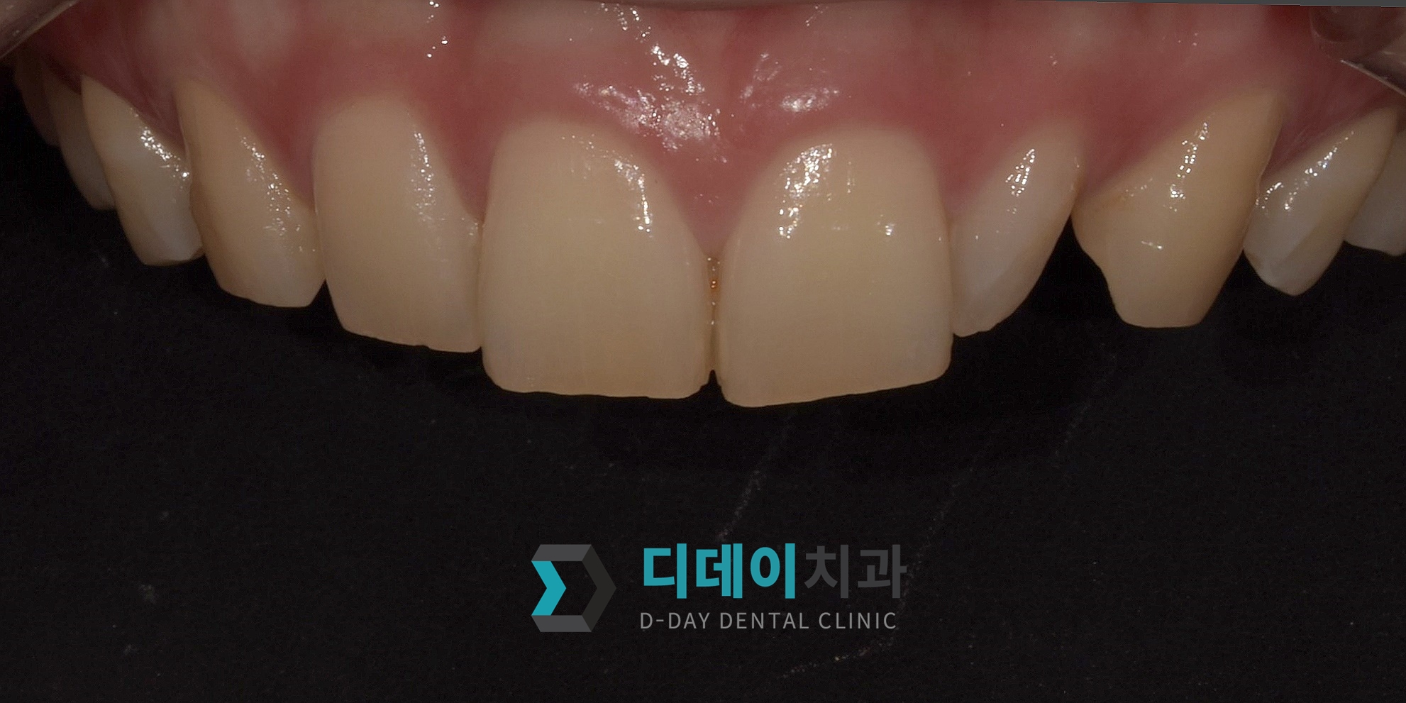 라미네이트 치료 전