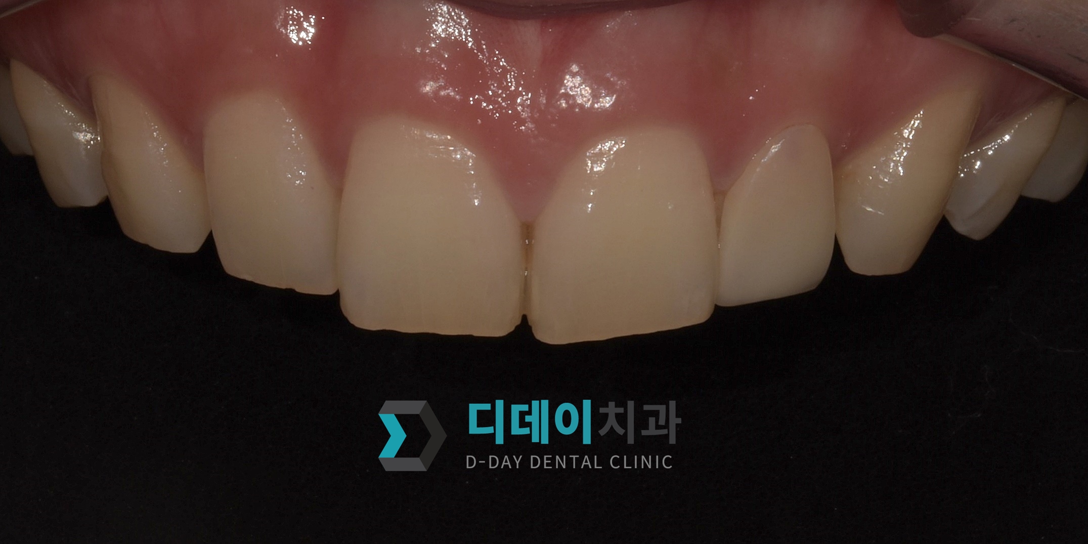 라미네이트 치료 후