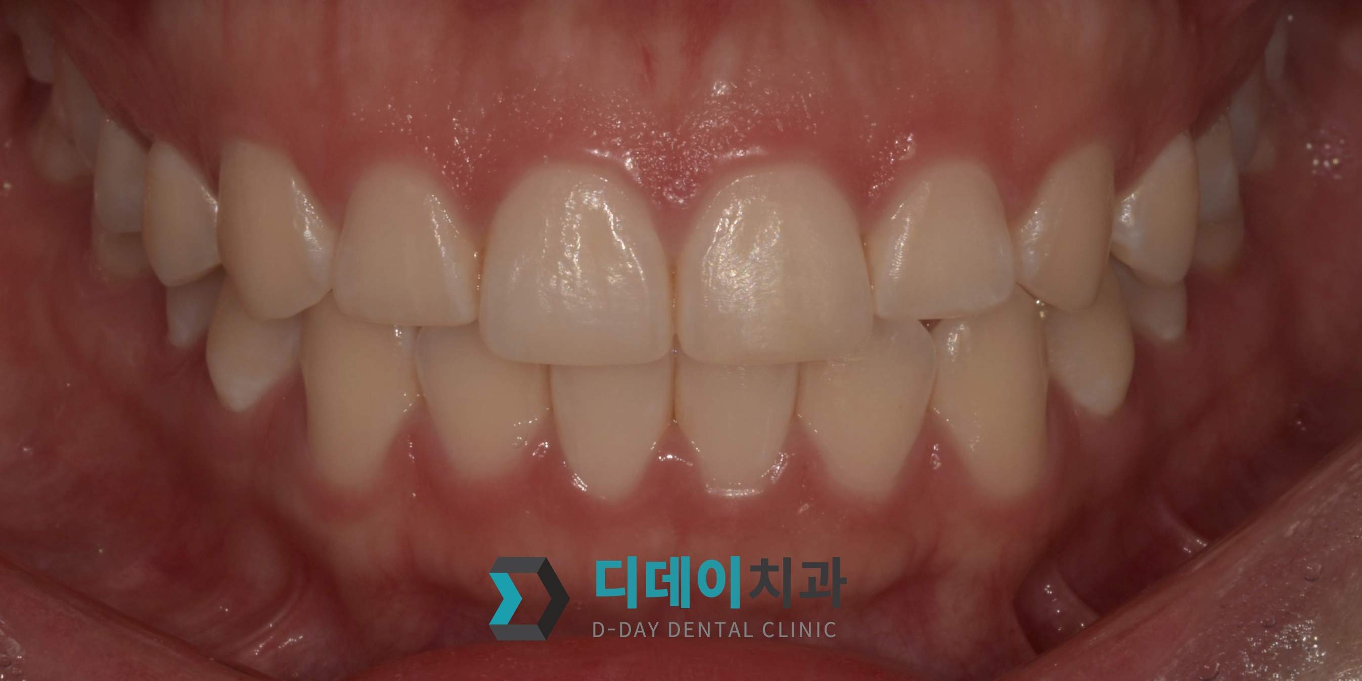 잇몸 성형 치료 전