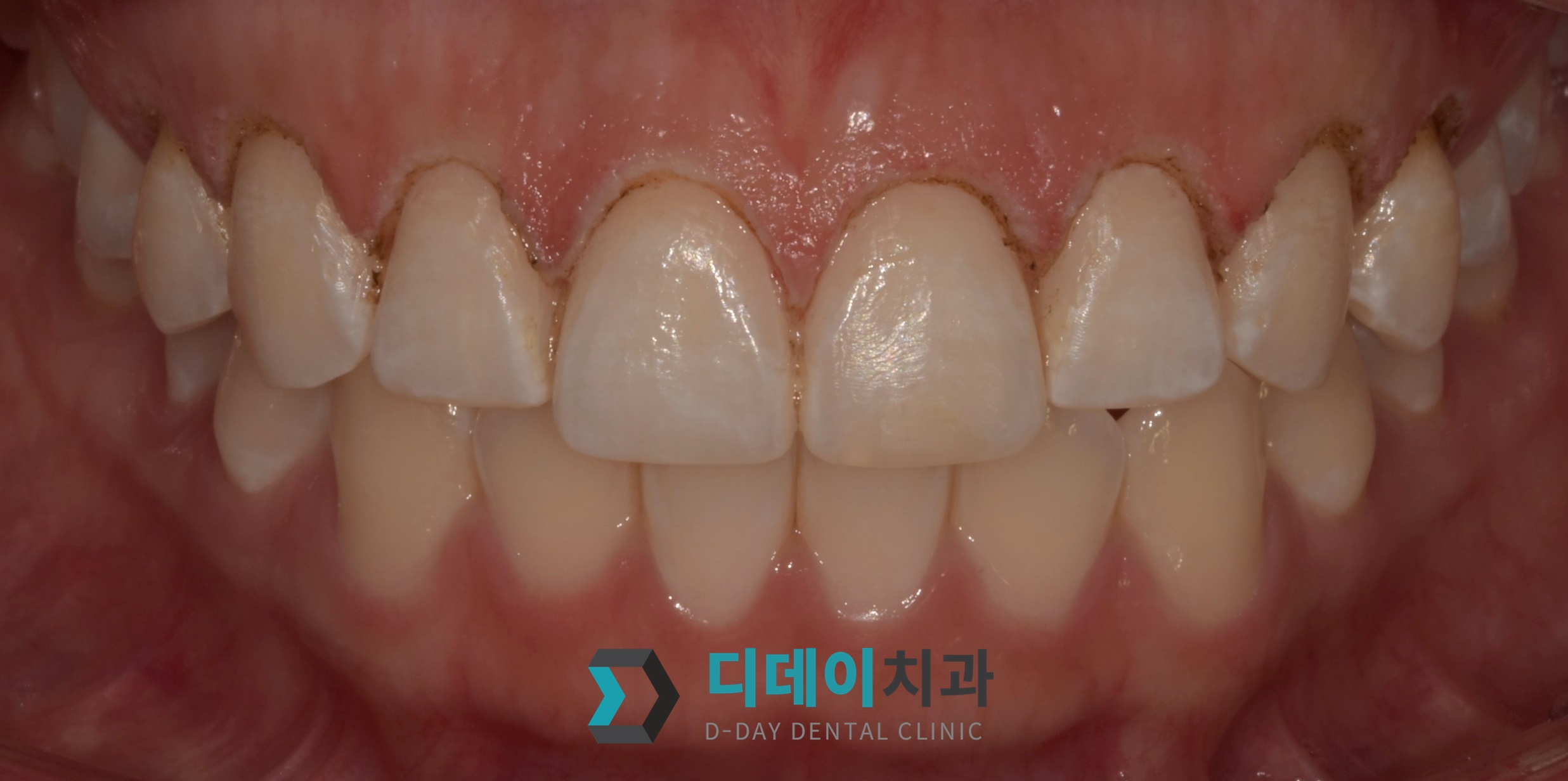 잇몸 성형 치료 후