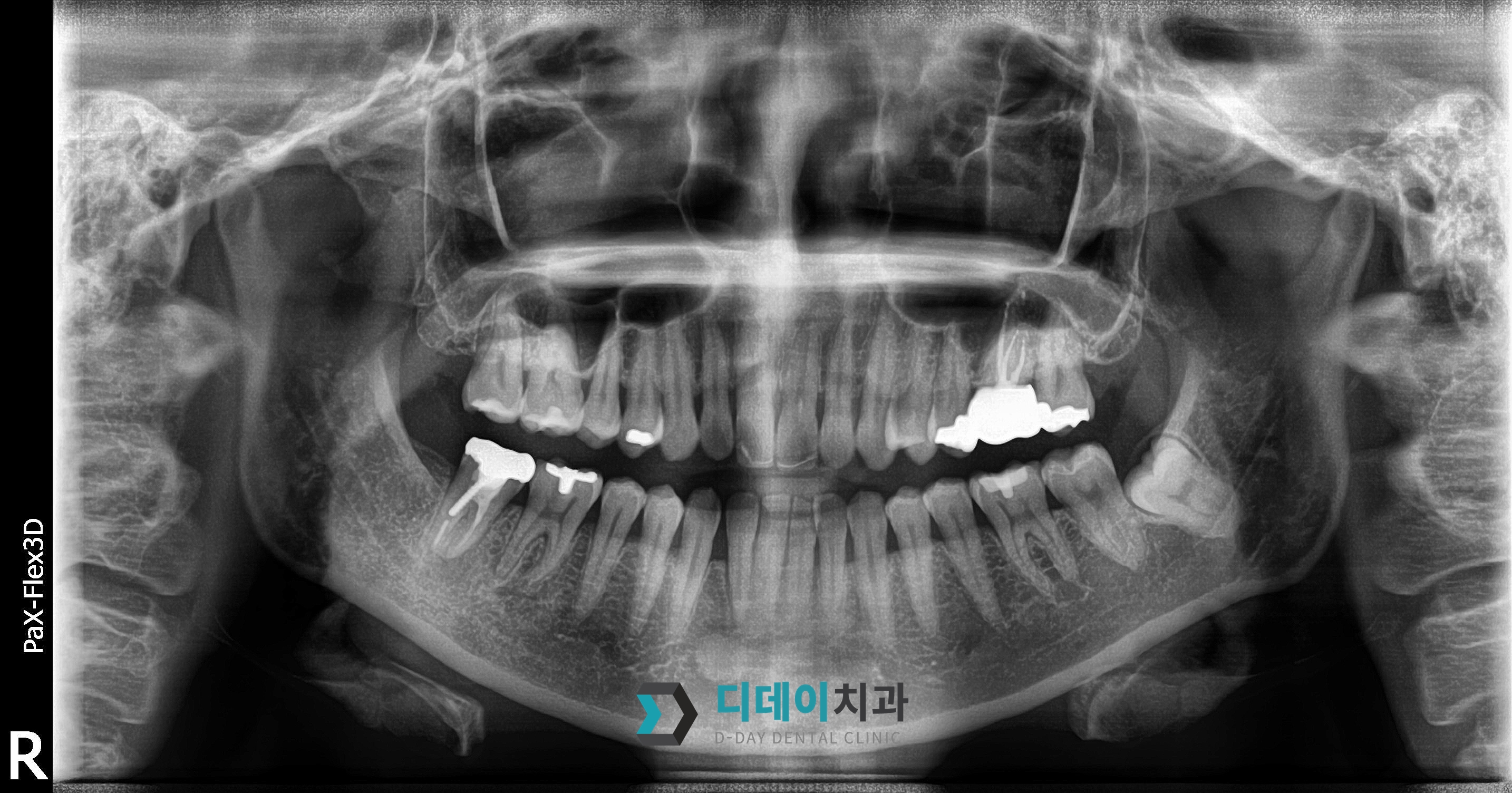임플란트 (발치후 지연식립) 치료 전