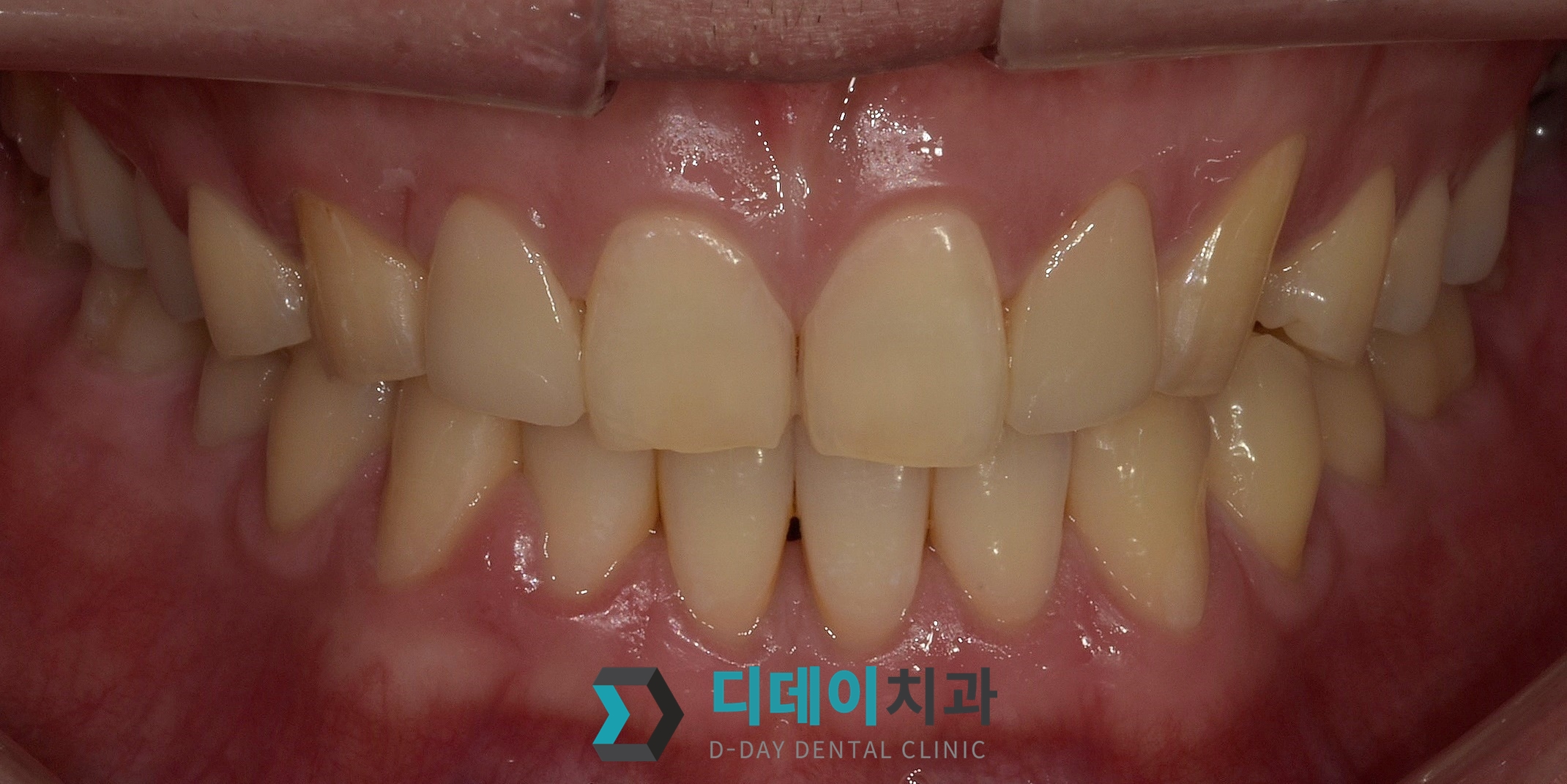 라미네이트 치료 후