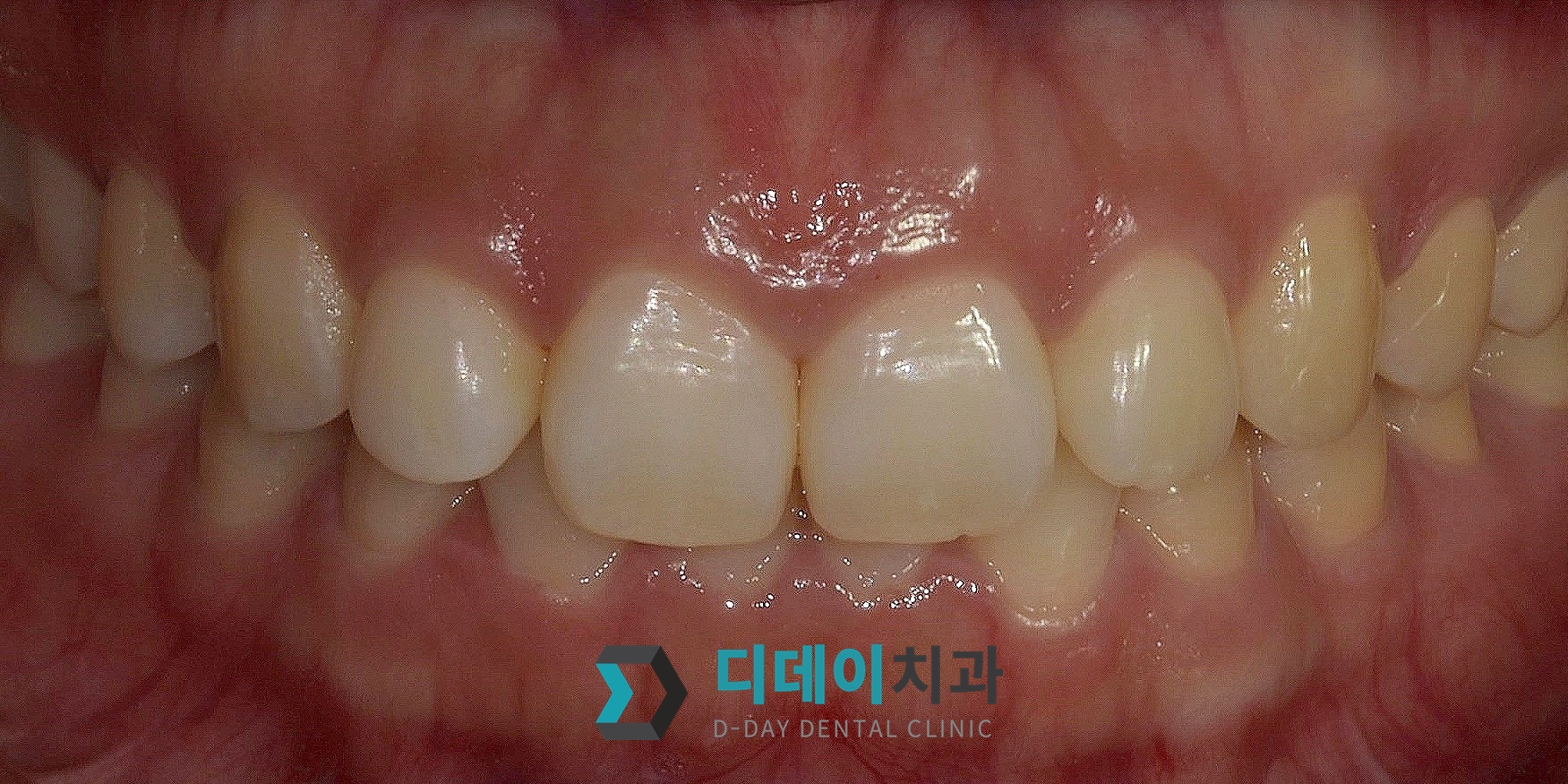 잇몸 성형 치료 전