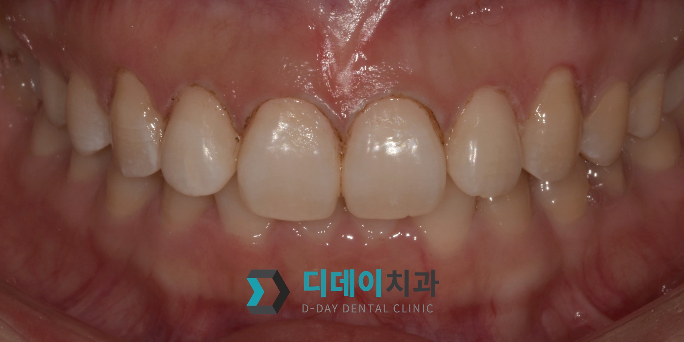 잇몸 성형 치료 후