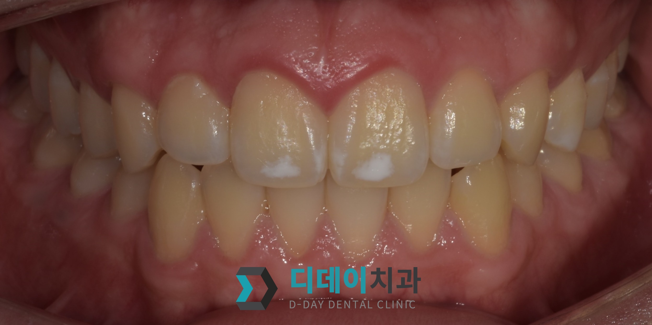 라미네이트 치료 전