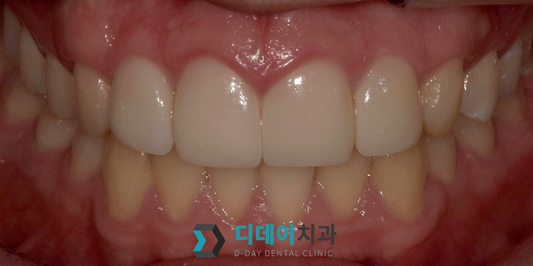 라미네이트 치료 후