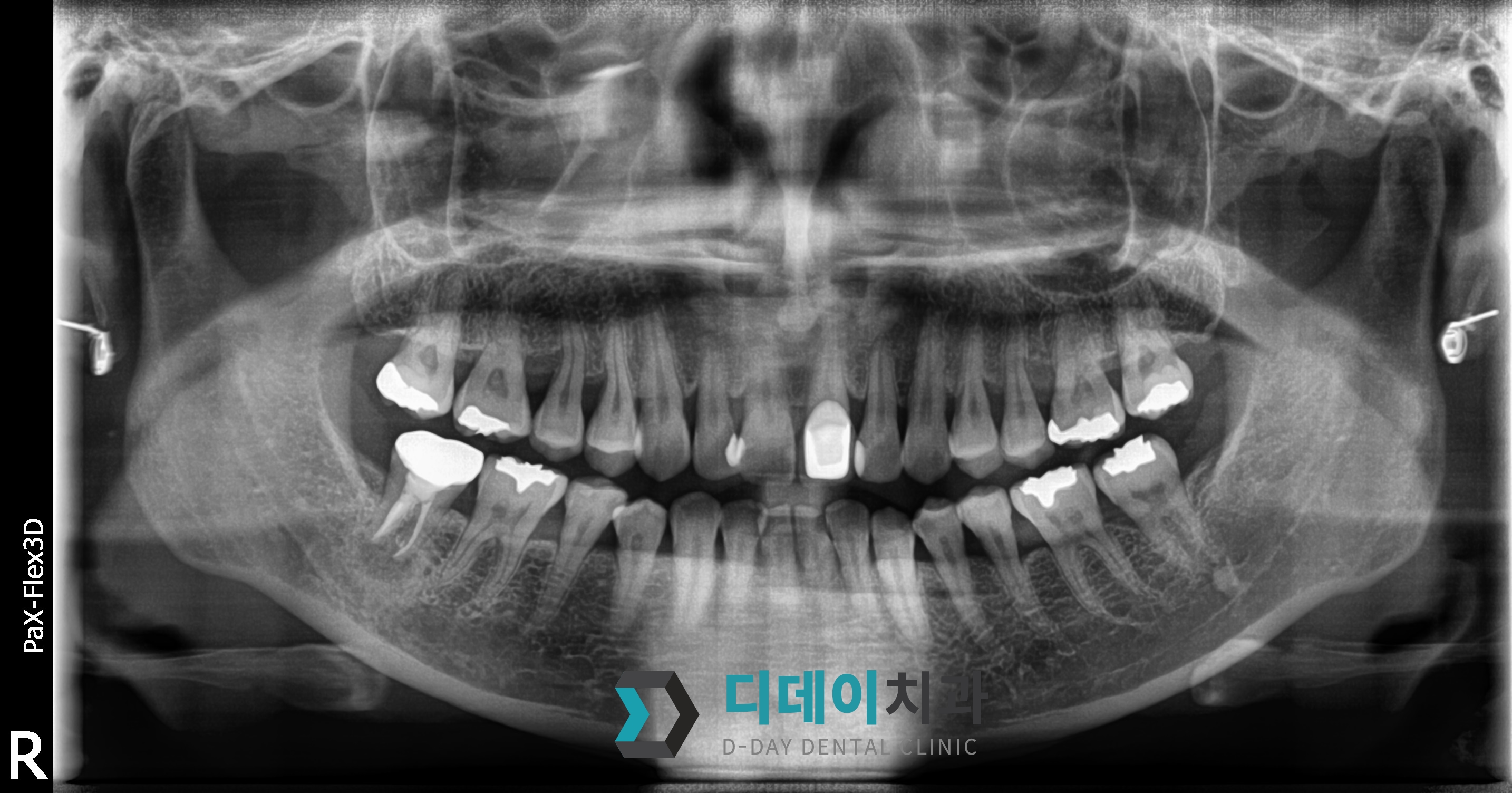 임플란트 (발치후 지연식립) 치료 전
