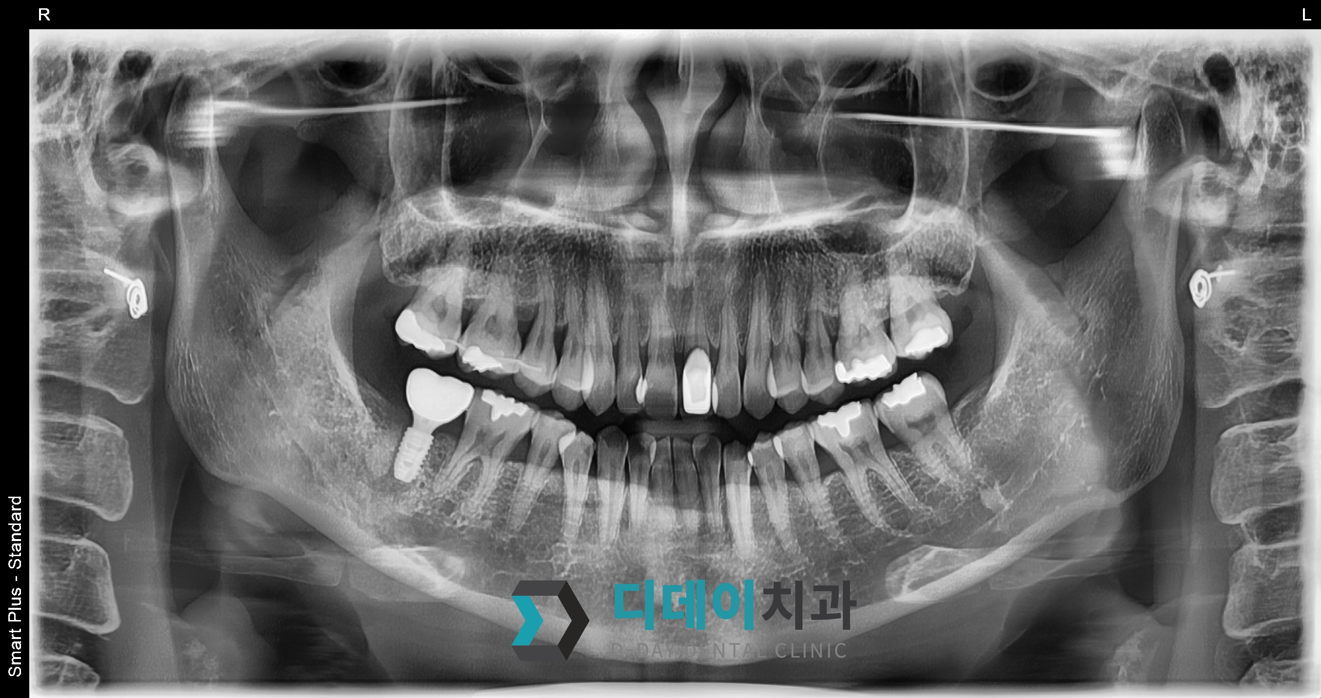 임플란트 (발치후 지연식립) 치료 후