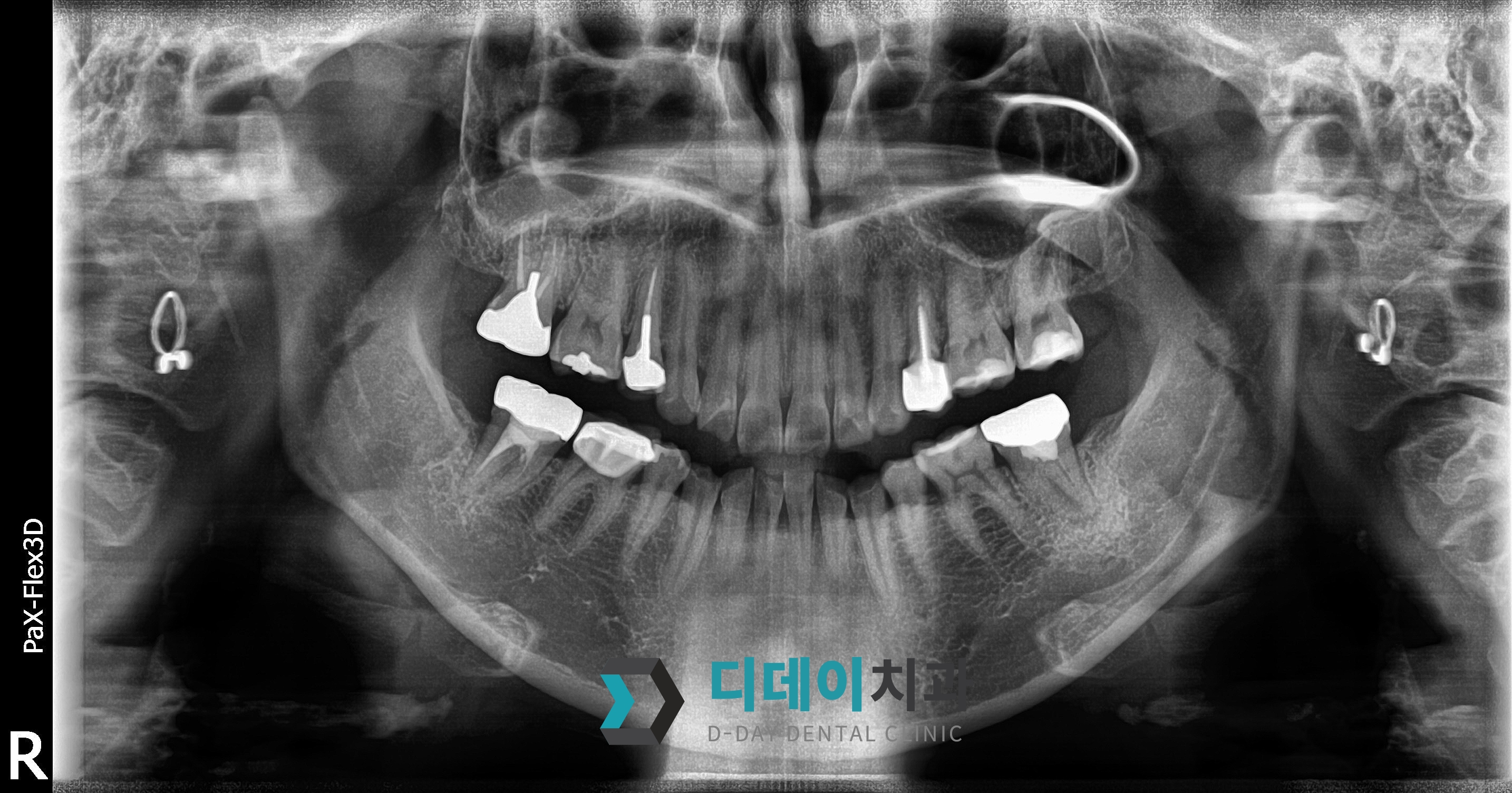 임플란트 (발치후 지연식립) 치료 전