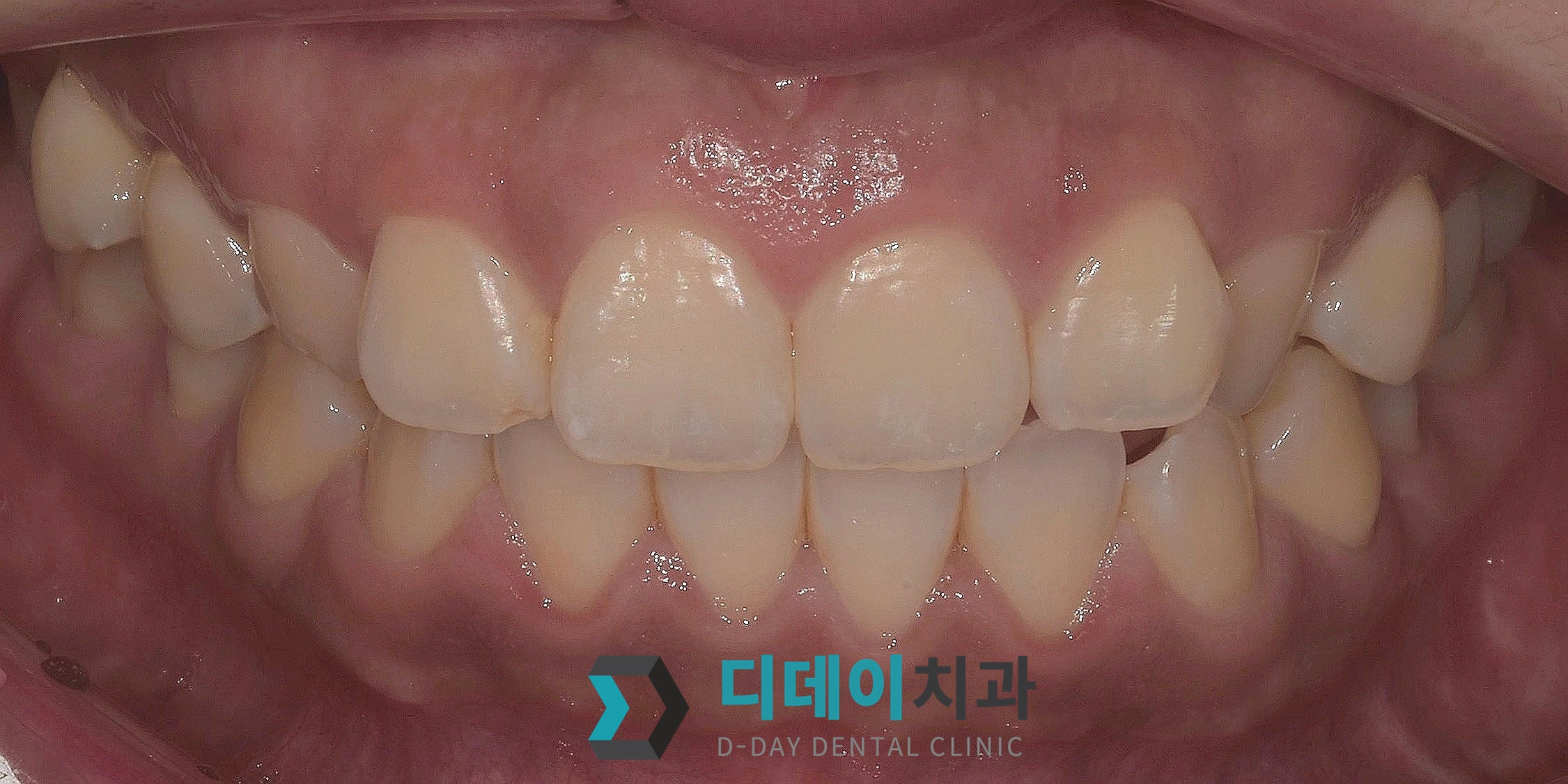 라미네이트 + 잇몸성형 치료 전