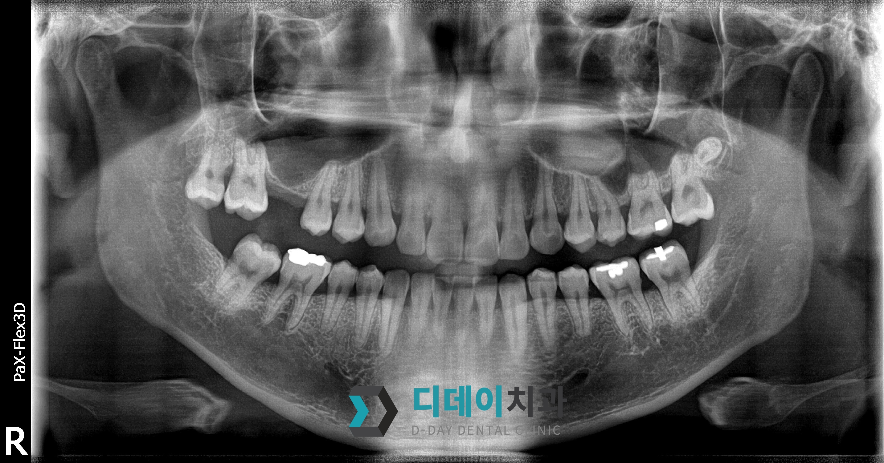 임플란트 (상악동 거상술) 치료 전