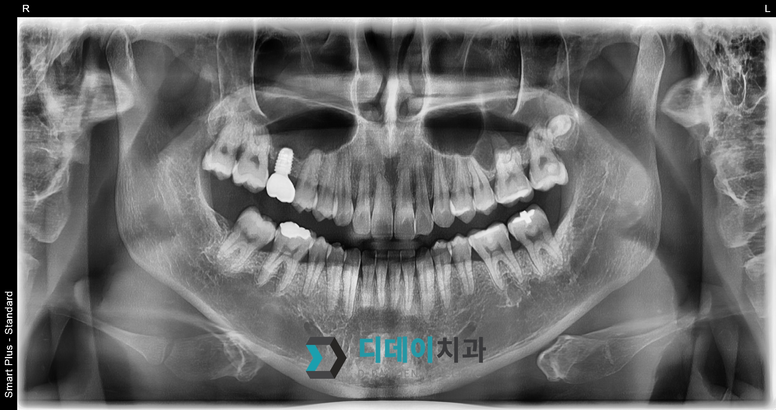 임플란트 (상악동 거상술) 치료 후