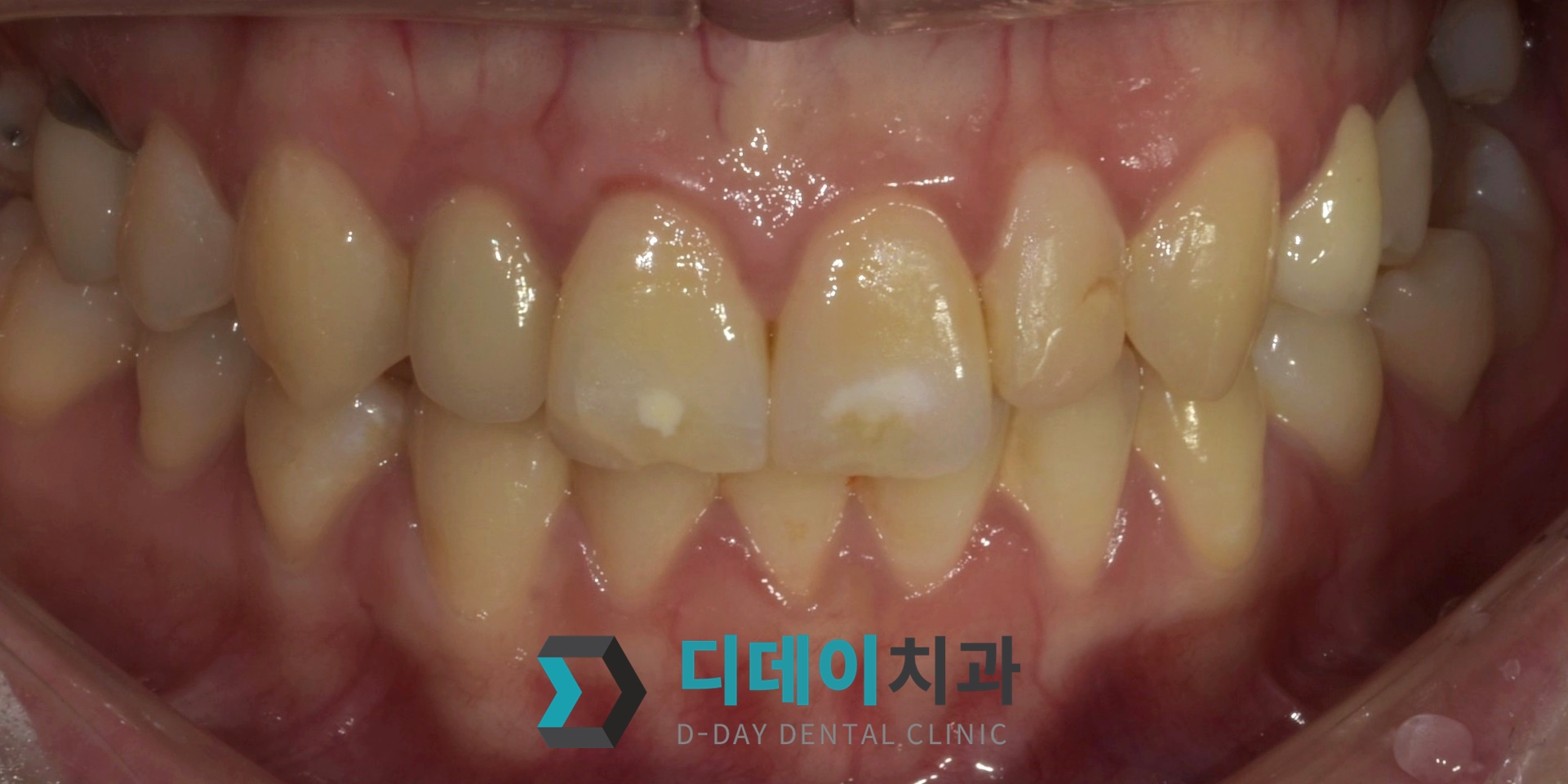 라미네이트 치료 전