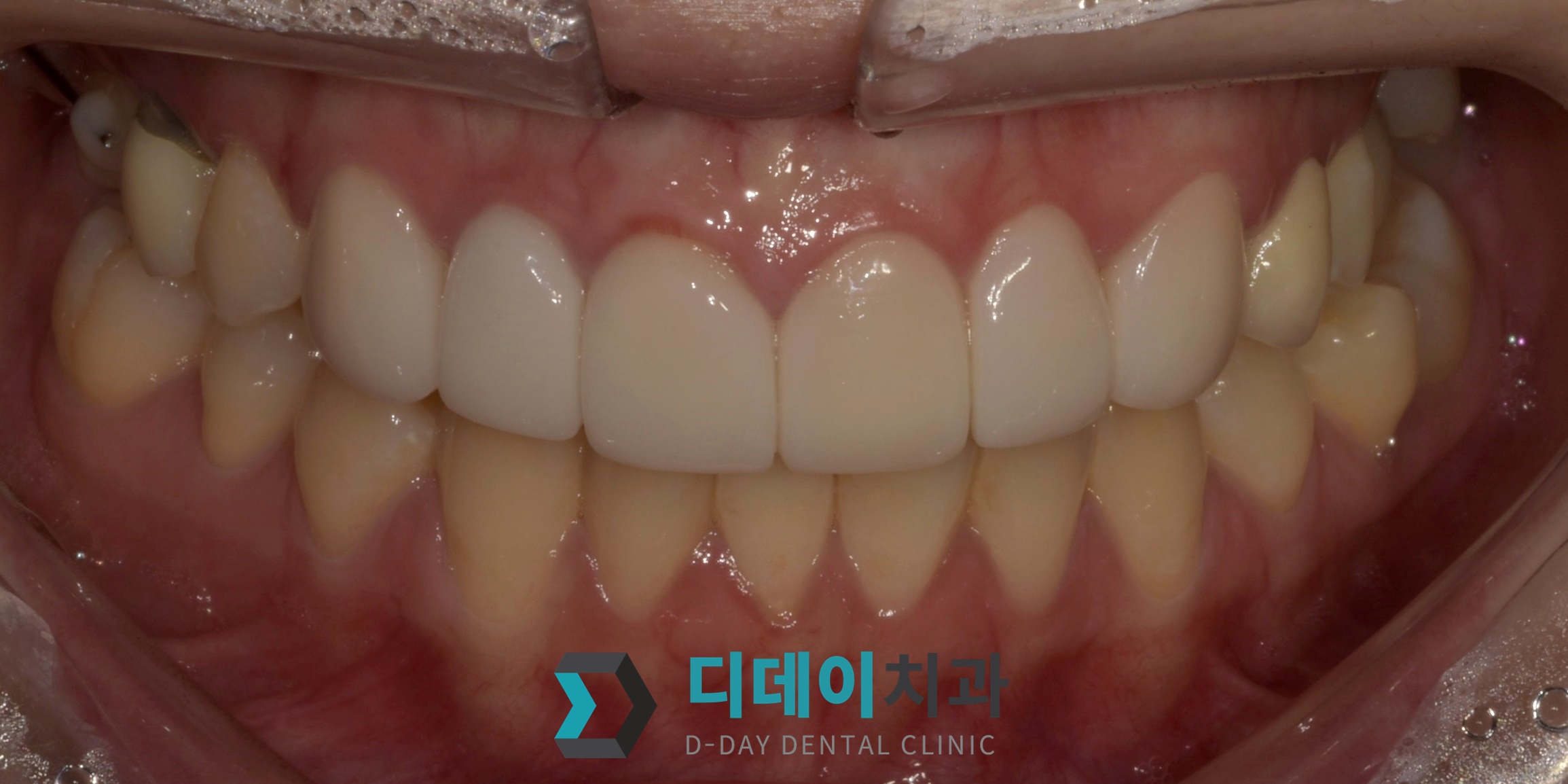 라미네이트 치료 후