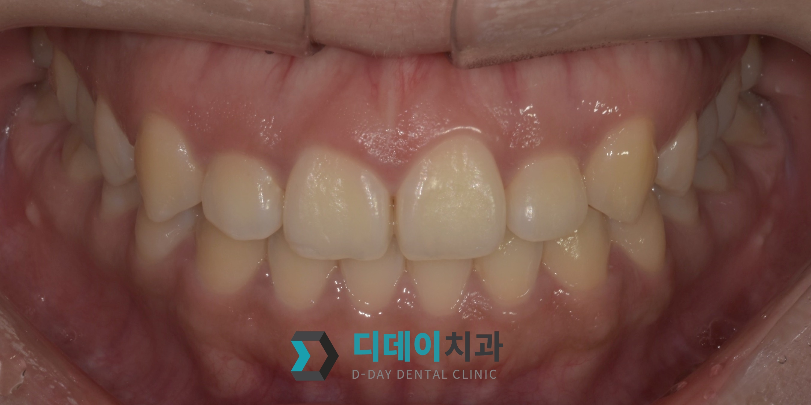 잇몸 성형 치료 전