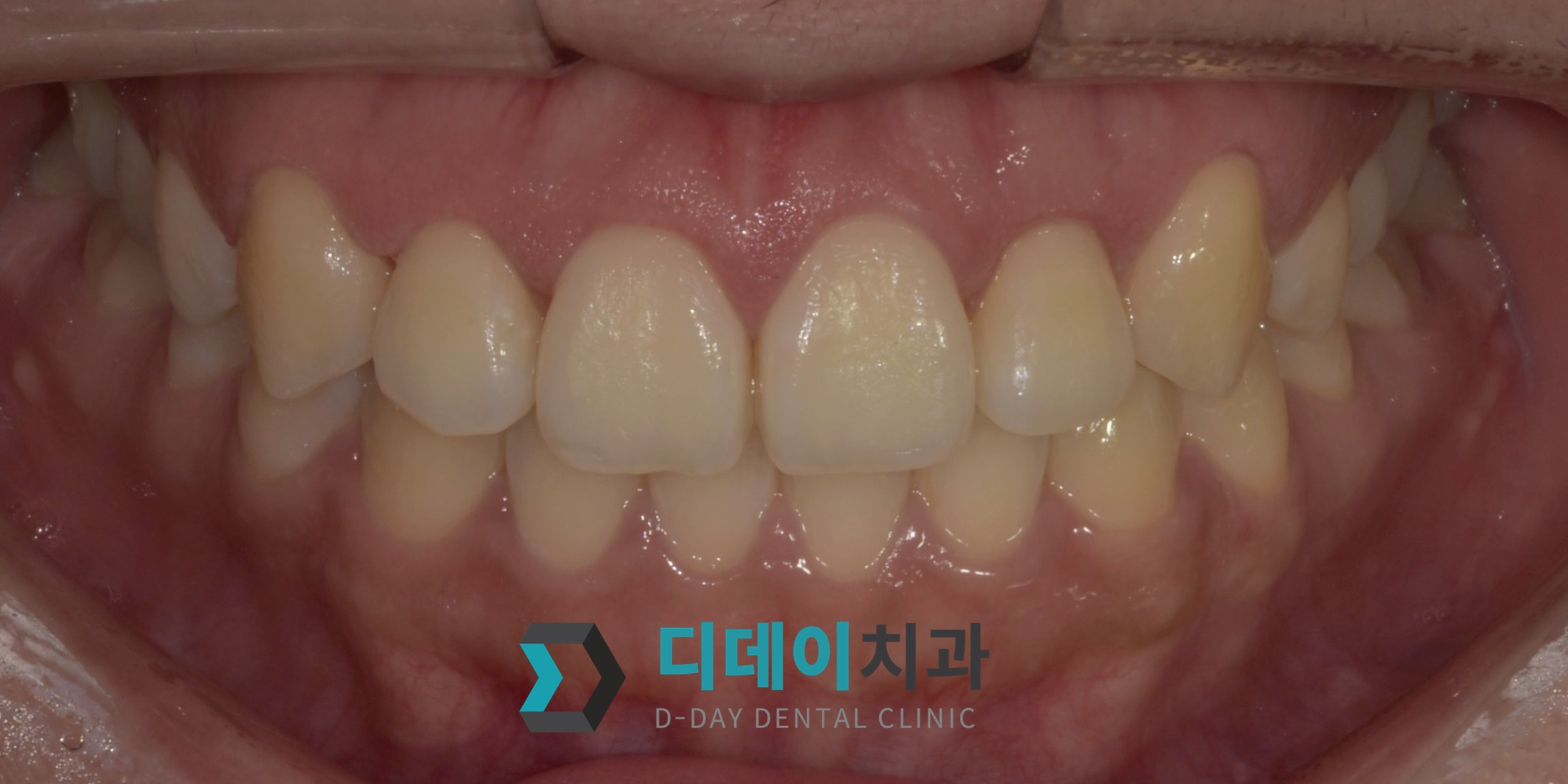 잇몸 성형 치료 후