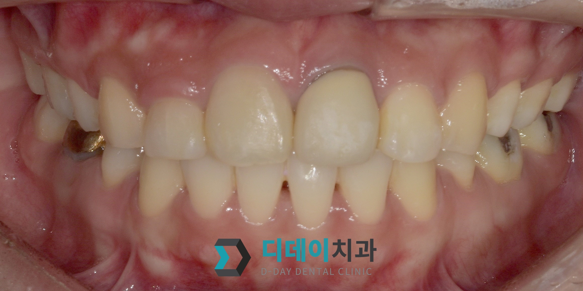 지르코니아 + 잇몸 성형 치료 전