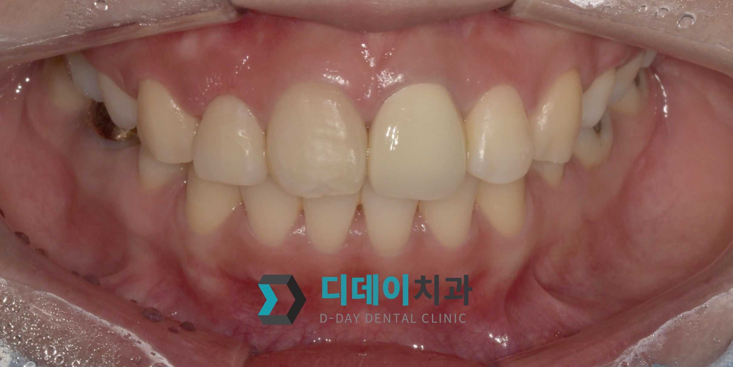 지르코니아 + 잇몸 성형 치료 후