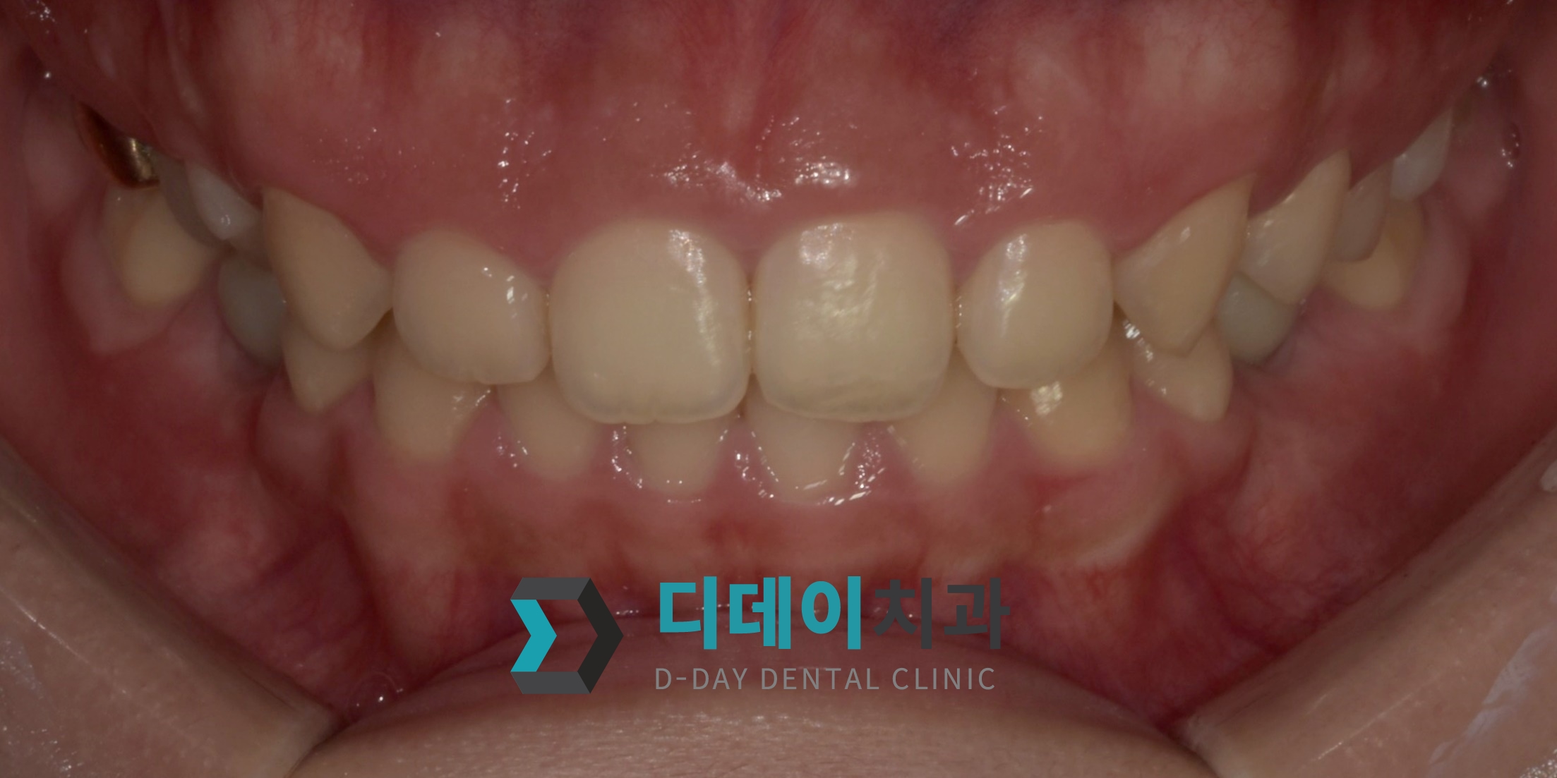 잇몸 성형 치료 전