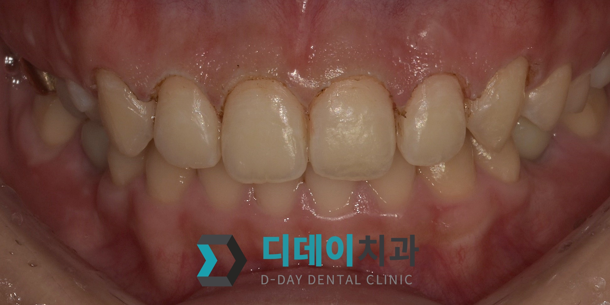 잇몸 성형 치료 후