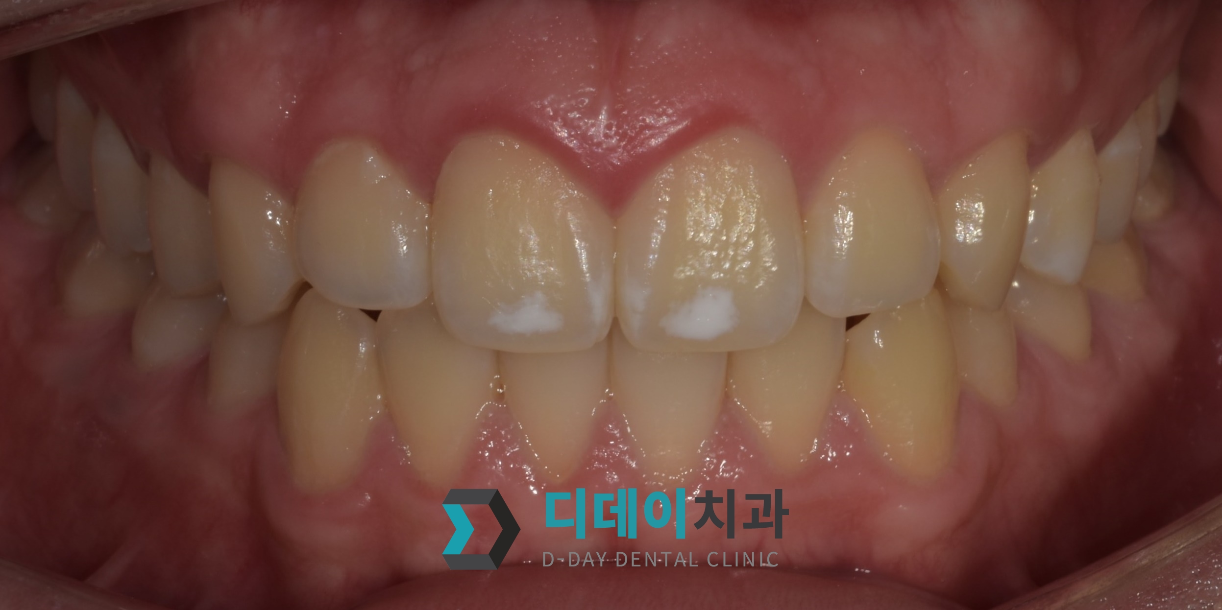 라미네이트 치료 전