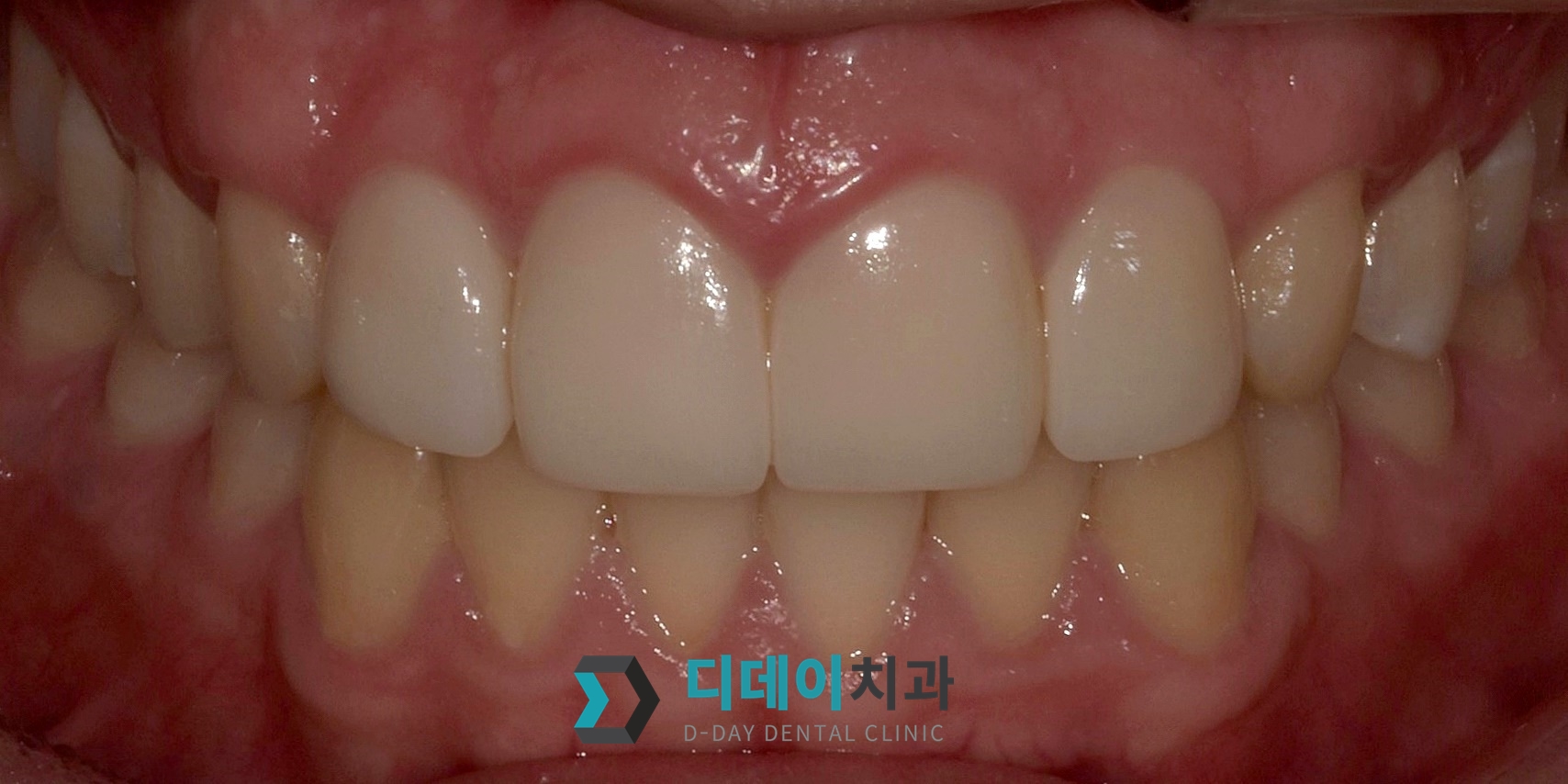 라미네이트 치료 후