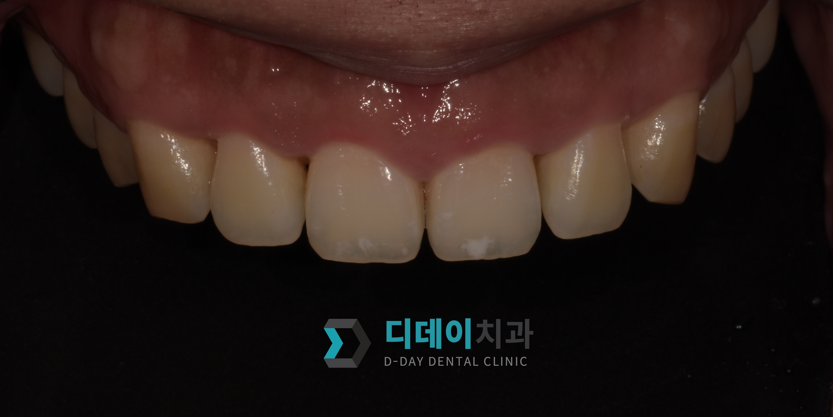 잇몸 성형 치료 전