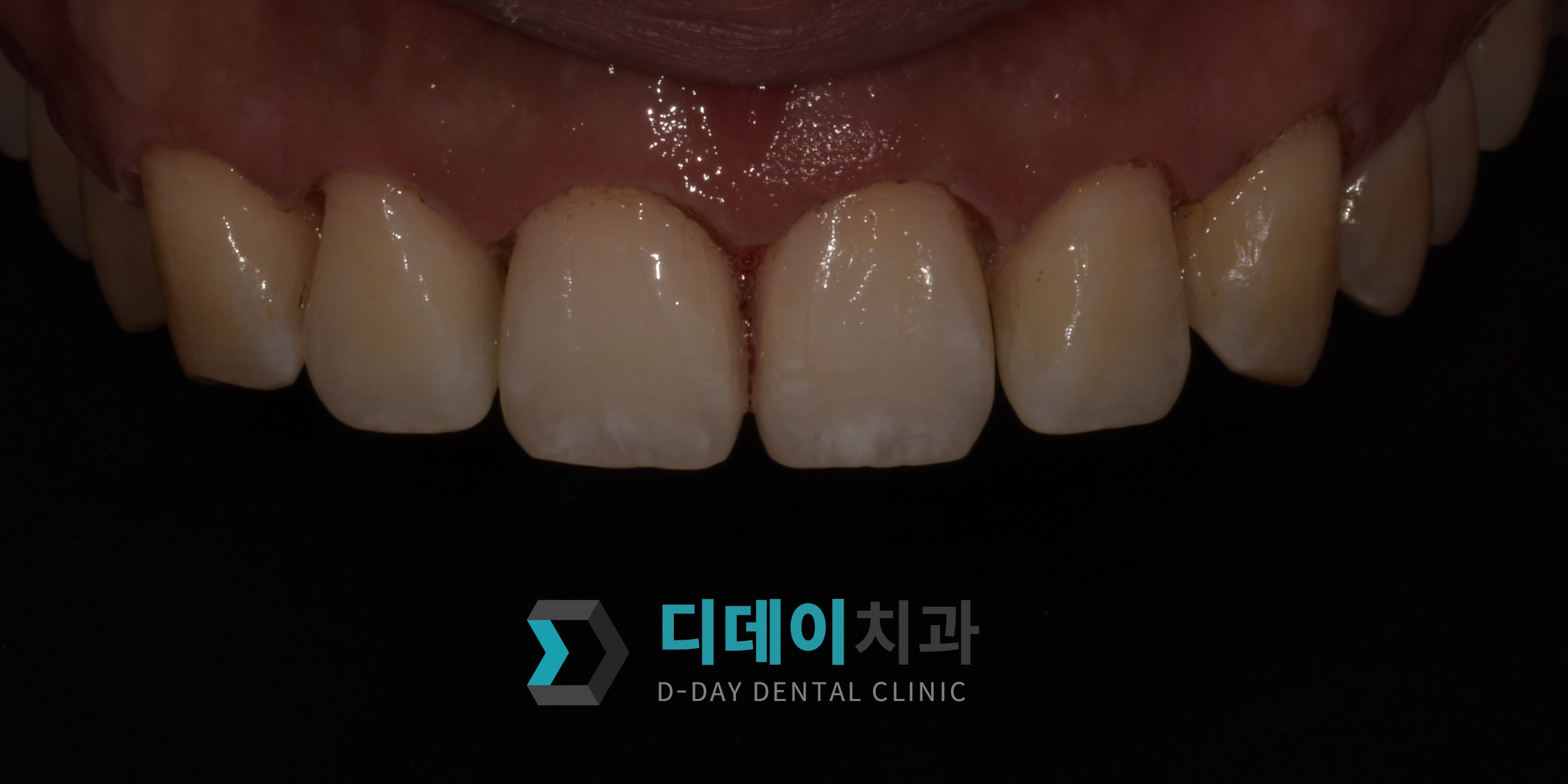 잇몸 성형 치료 후