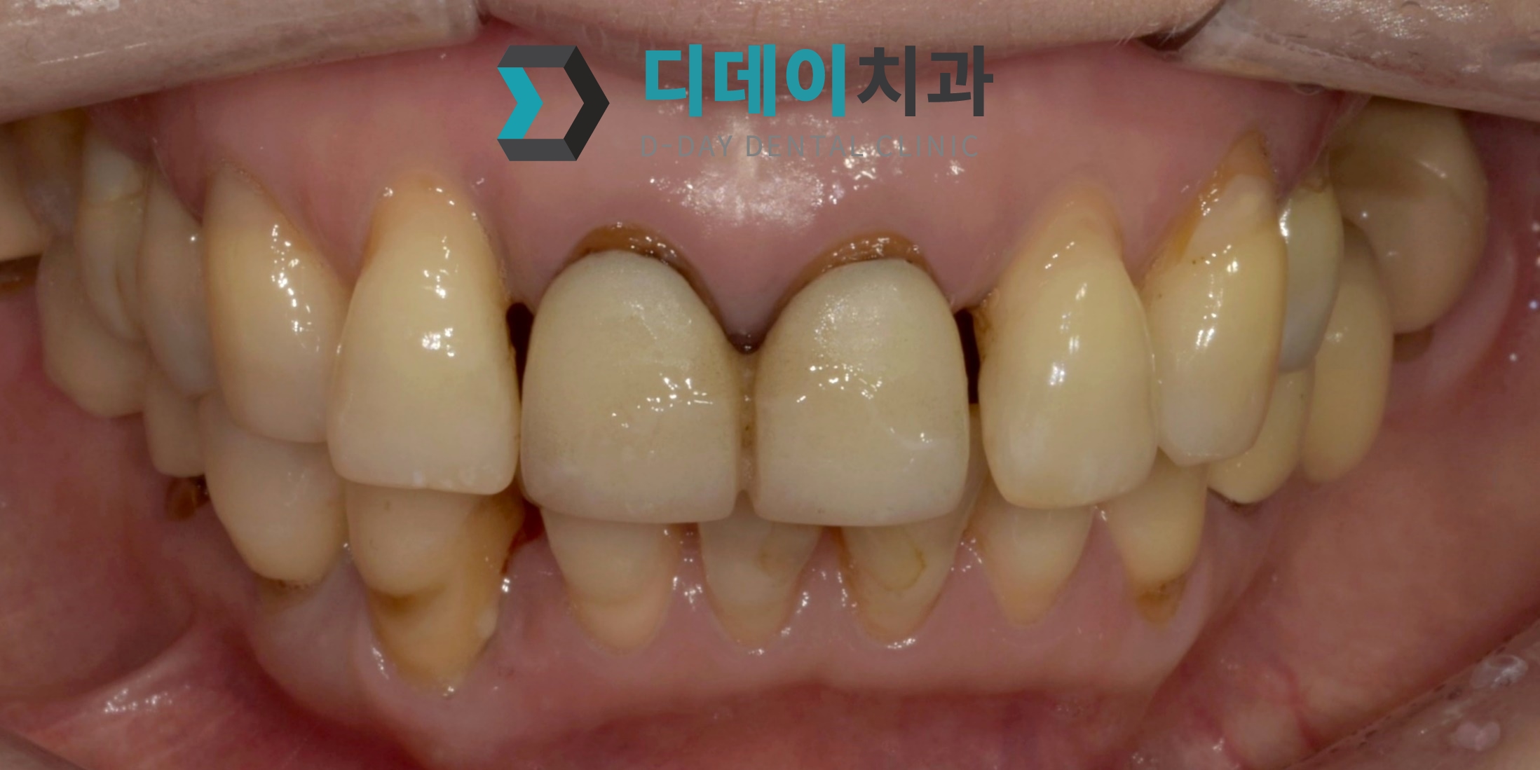심미보철치료 (지르코니아 크라운 교체) 치료 전