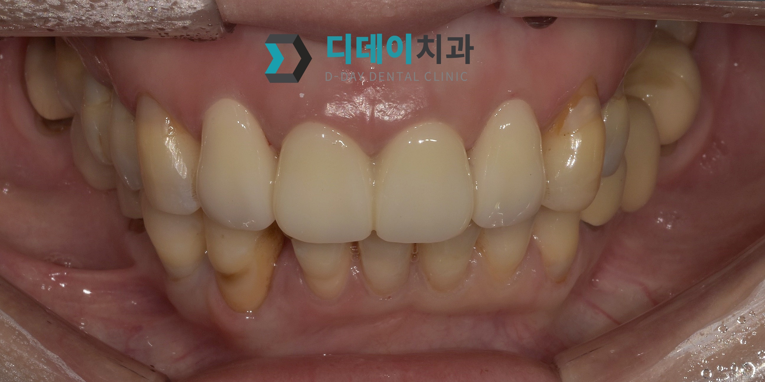 심미보철치료 (지르코니아 크라운 교체) 치료 후