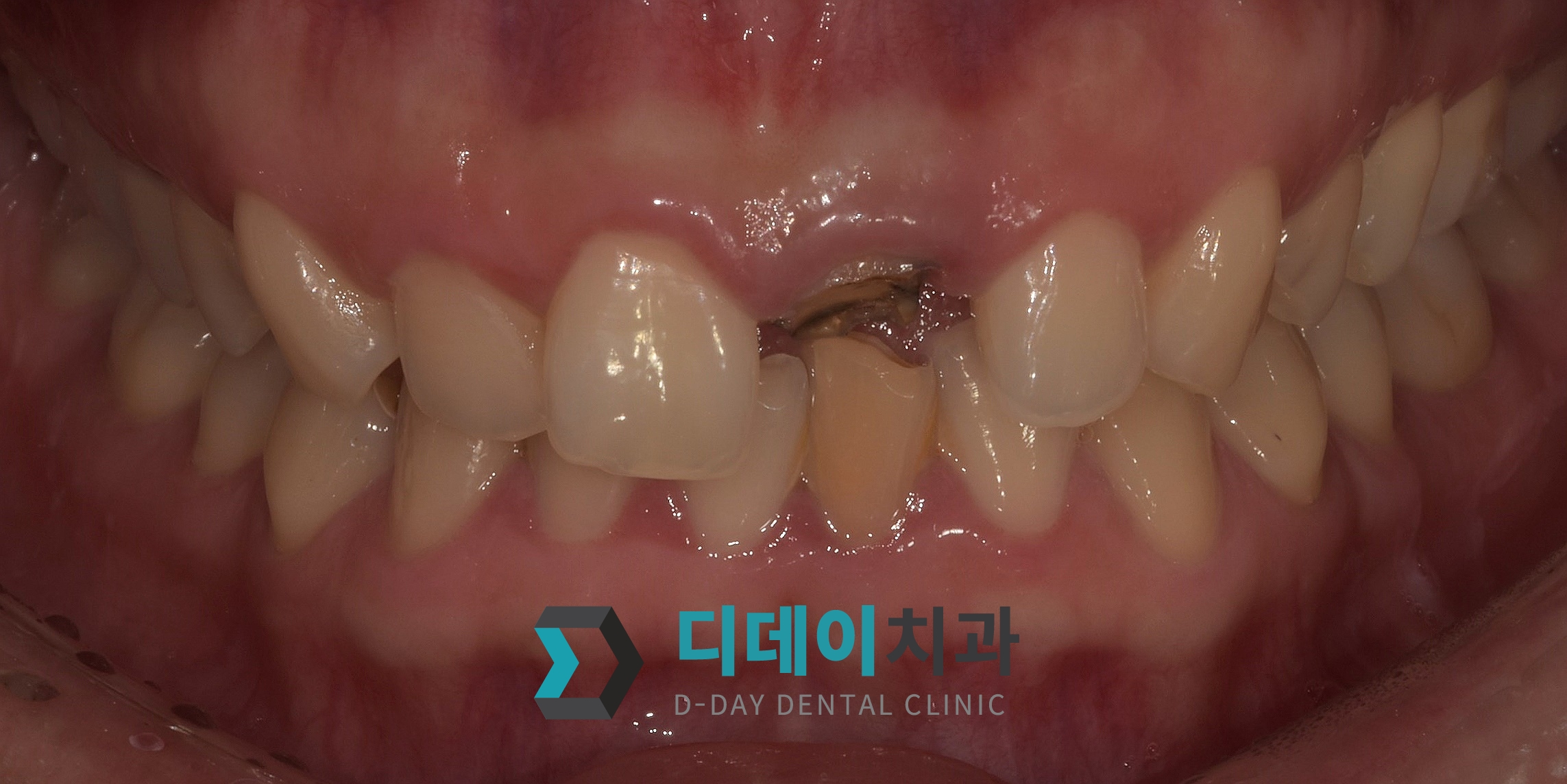 심미보철치료 (파절치아) 치료 전