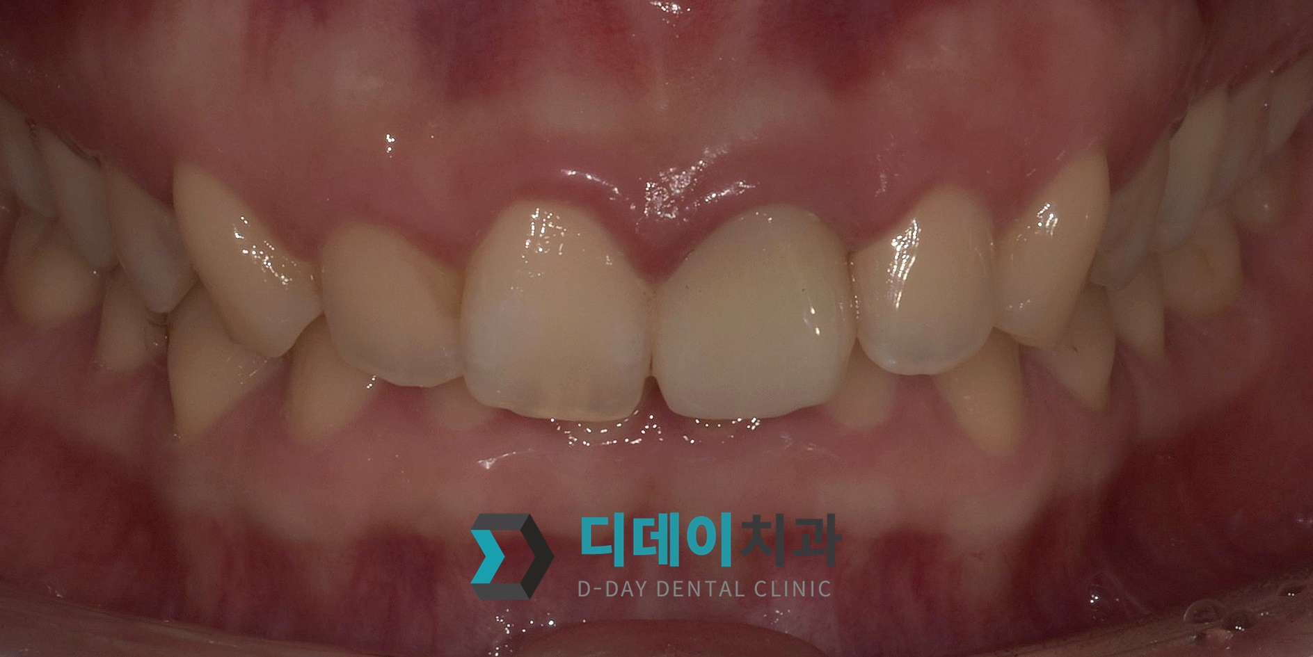 심미보철치료 (파절치아) 치료 후