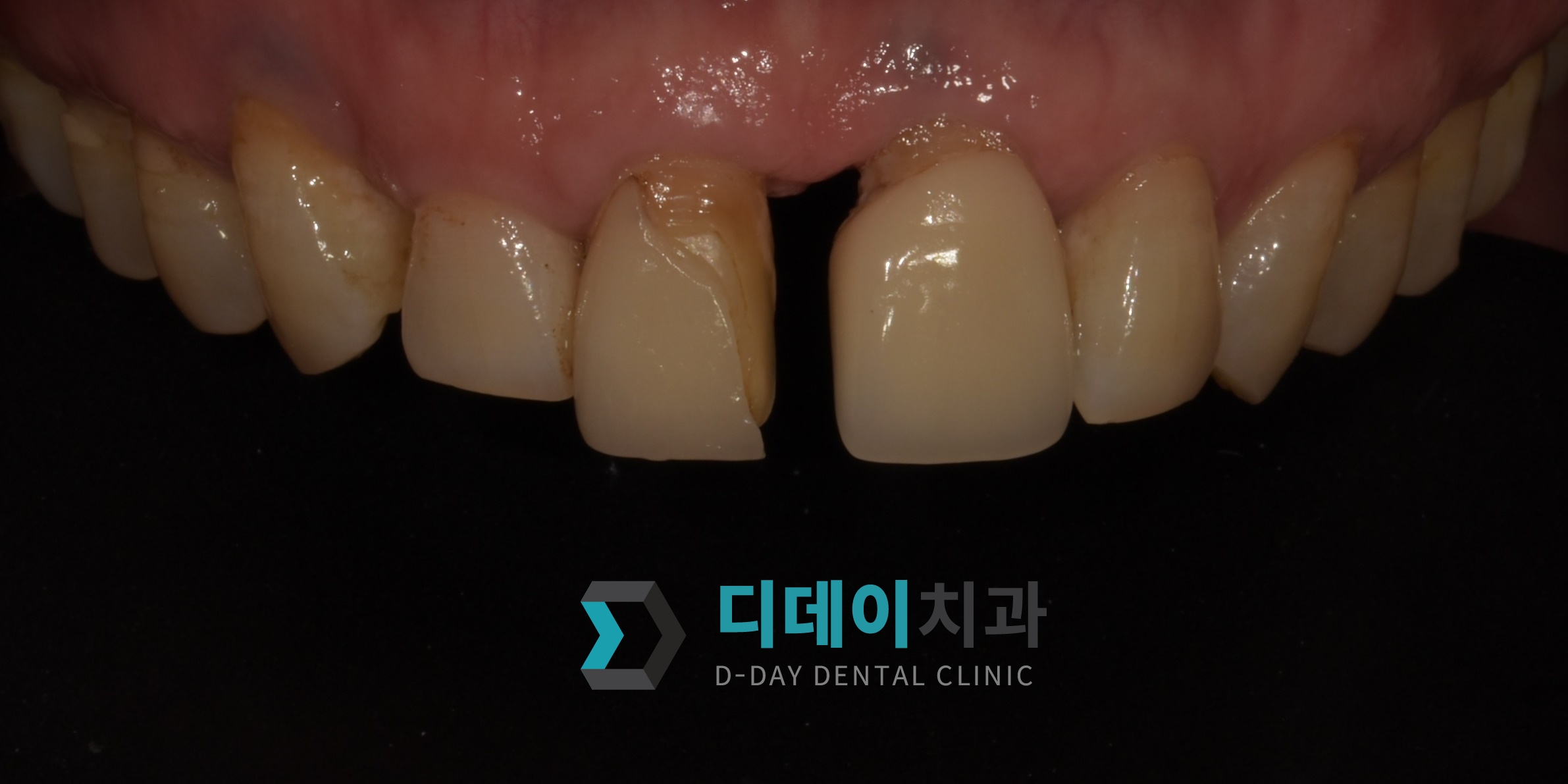 라미네이트 재시술 치료 전