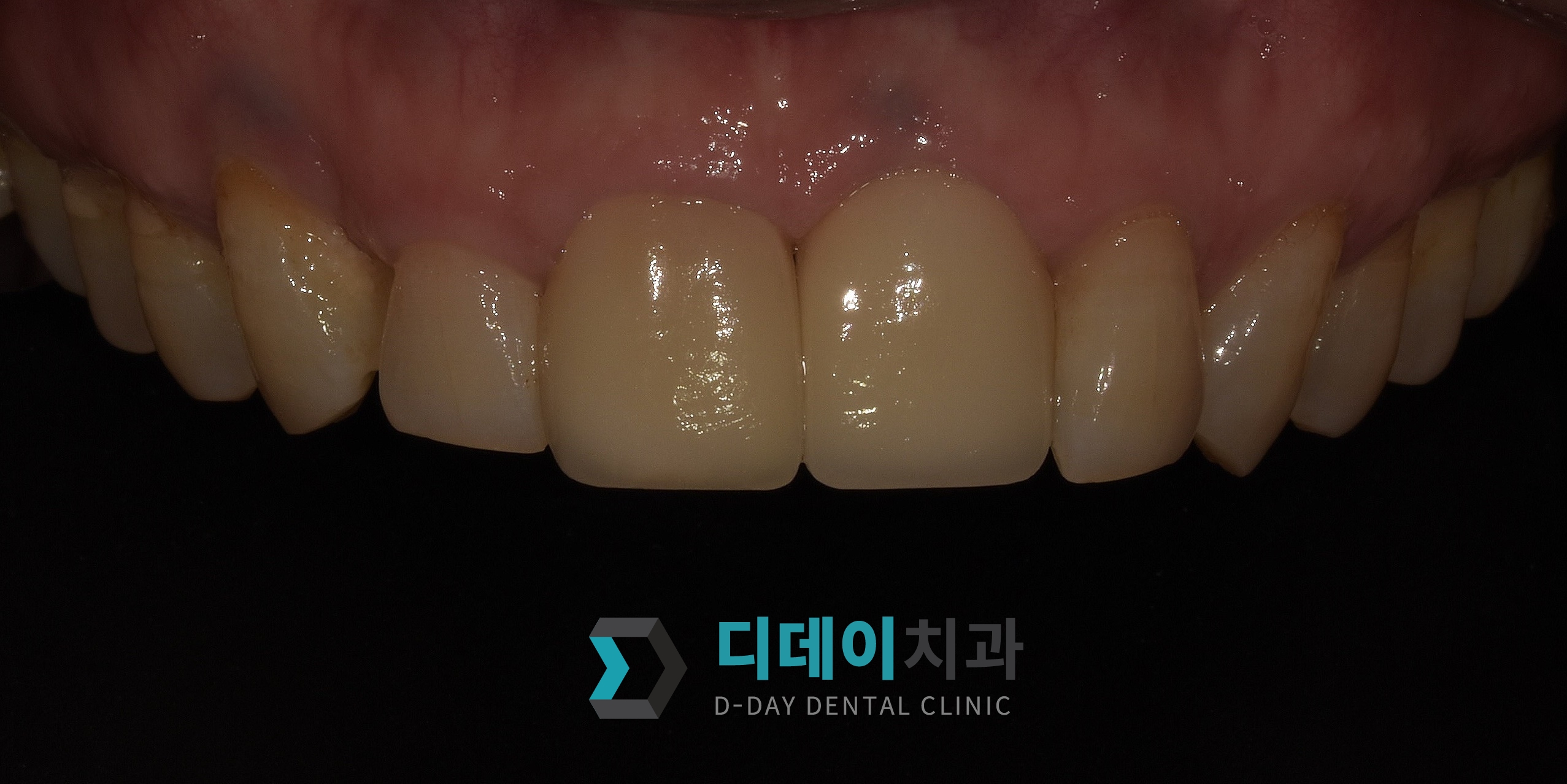 라미네이트 재시술 치료 후