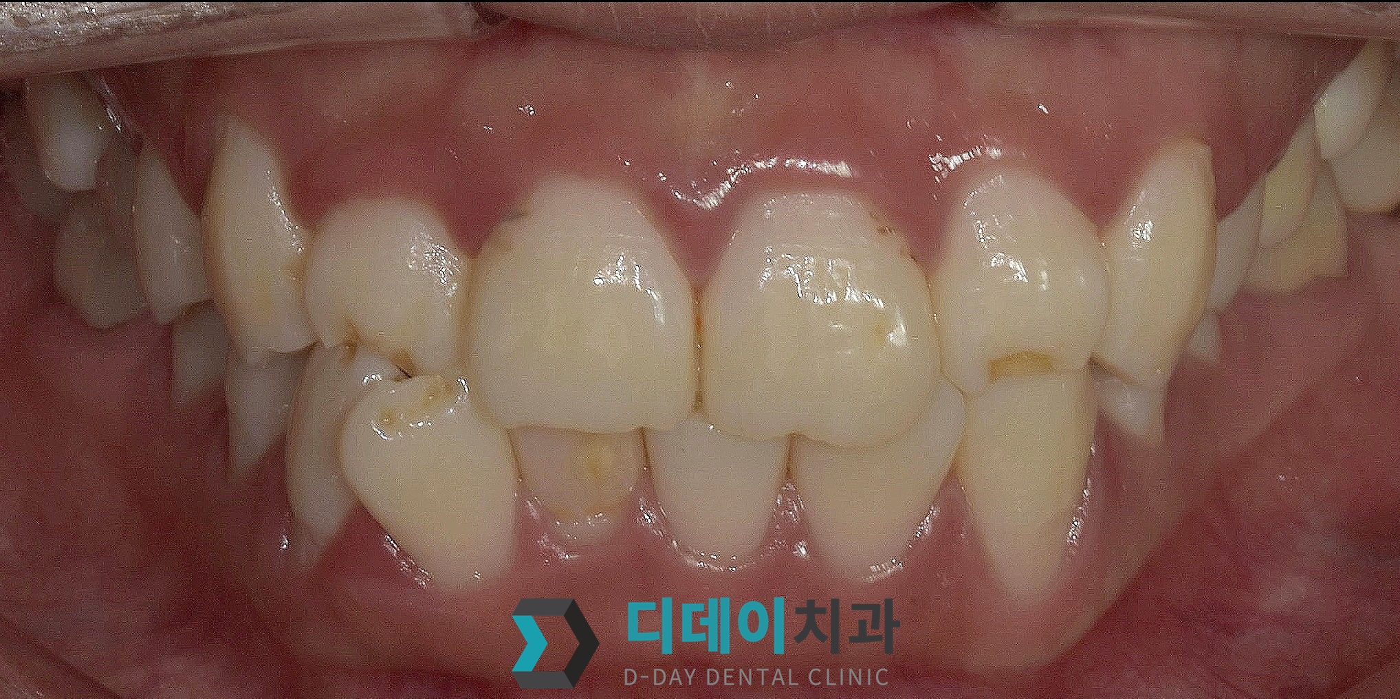 라미네이트 치료 전