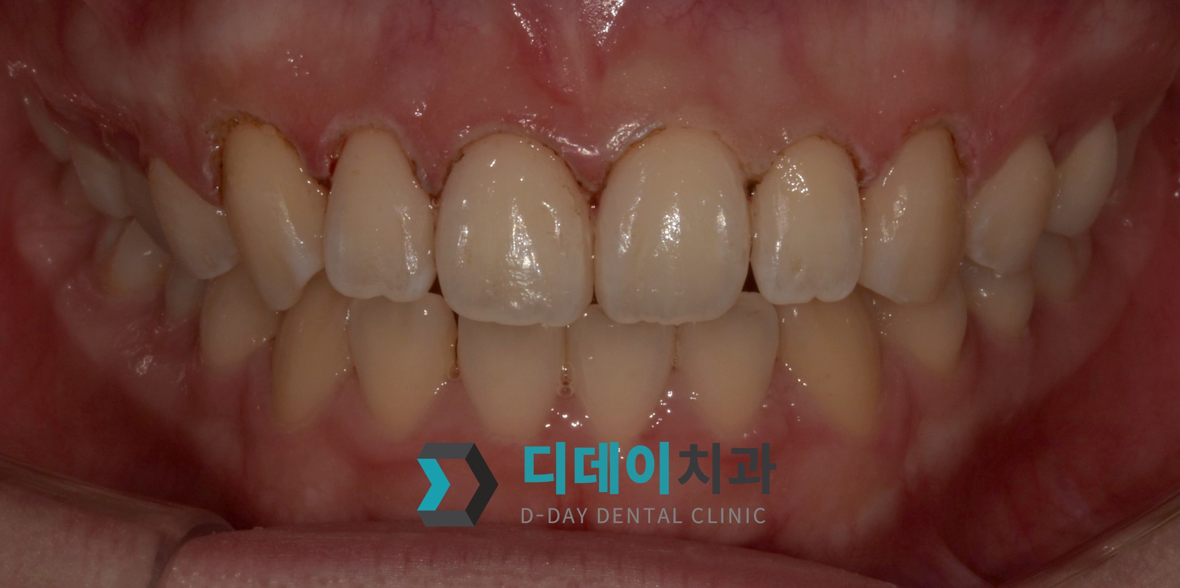 잇몸 성형 치료 후