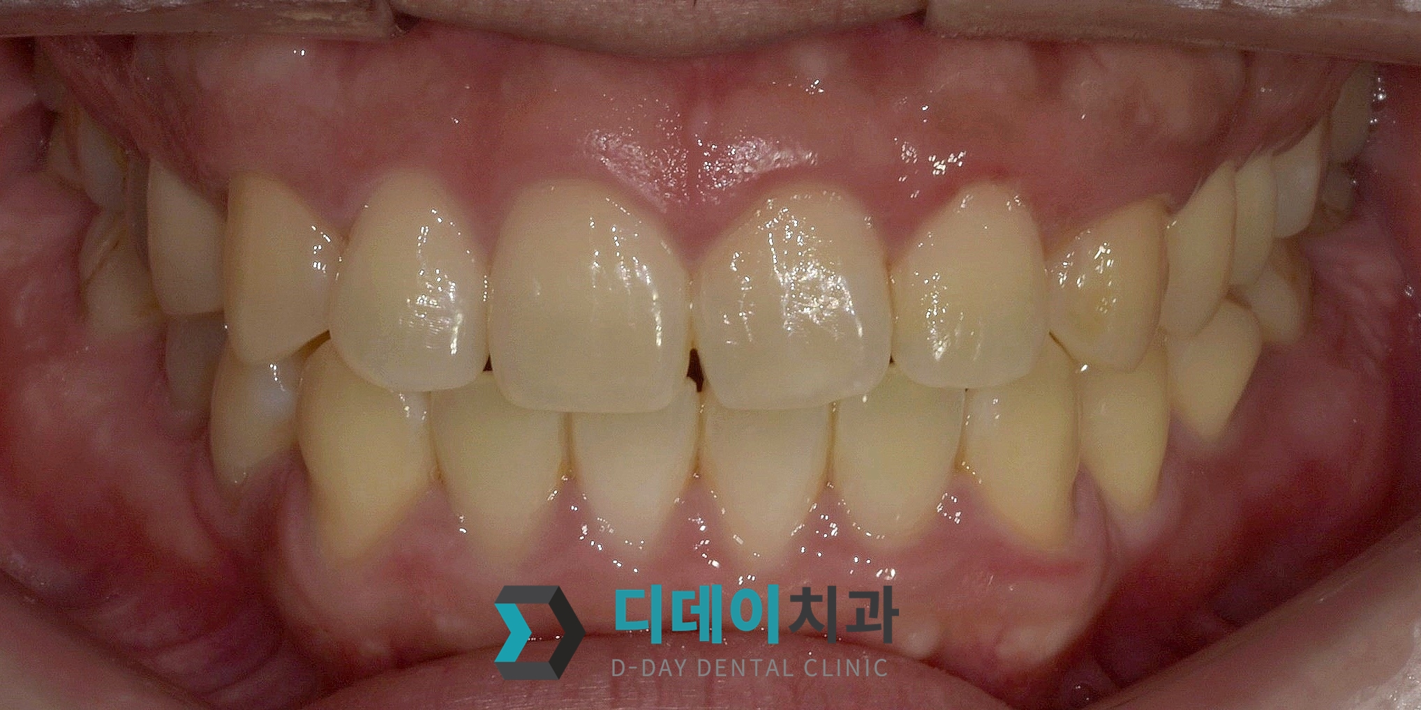라미네이트 치료 전