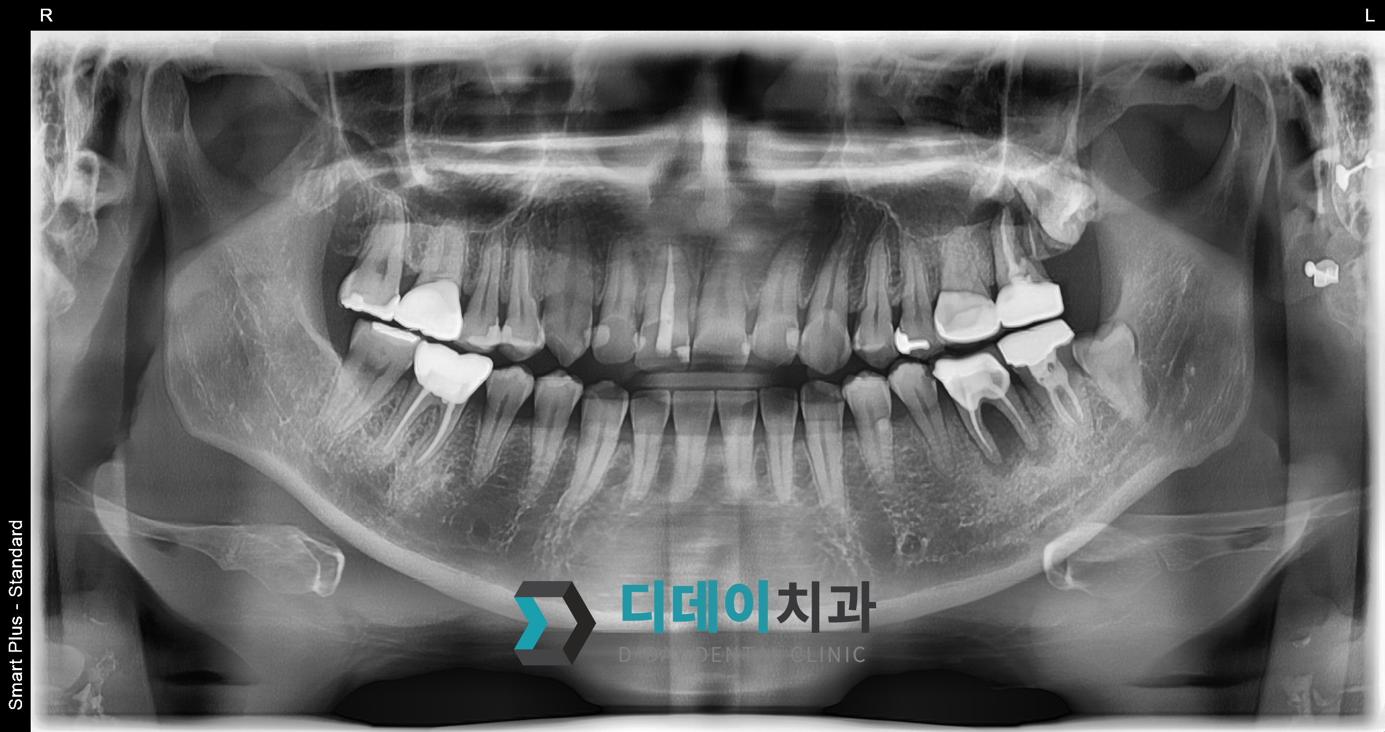 임플란트 (발치후 지연식립) 치료 전