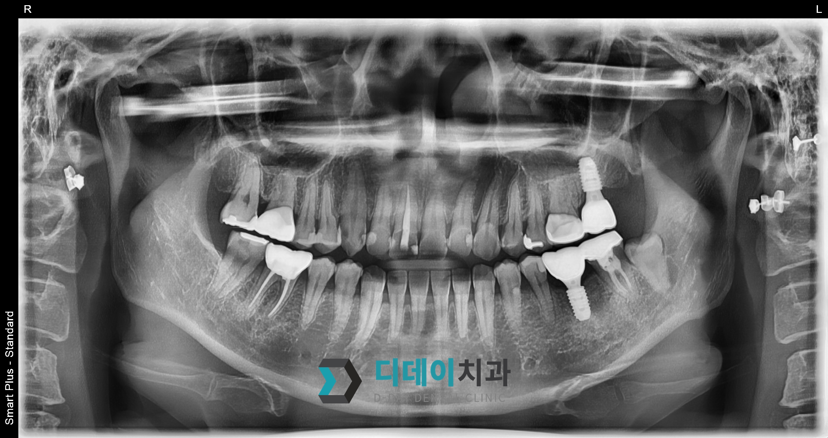 임플란트 (발치후 지연식립) 치료 후