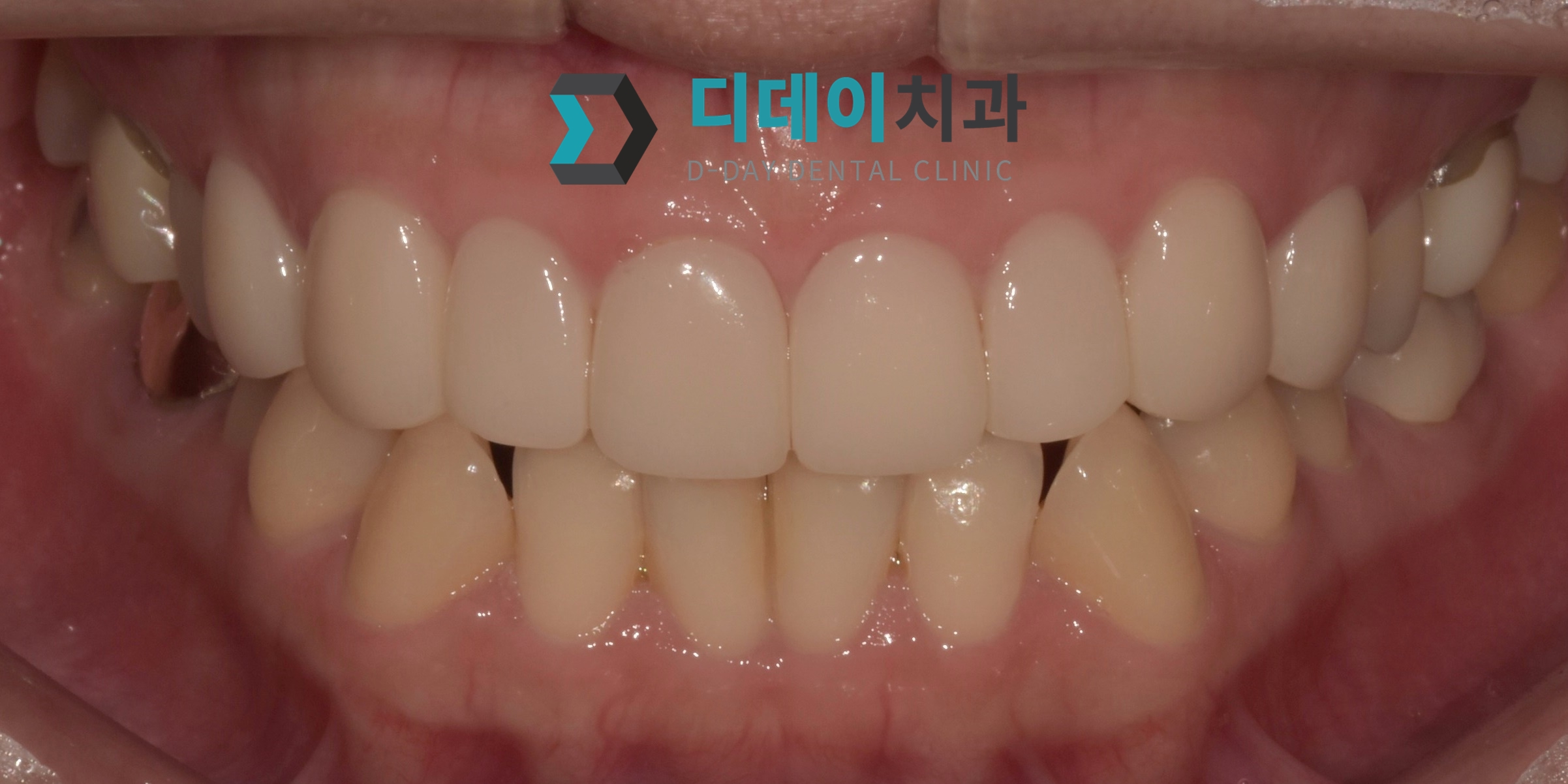 라미네이트 치료 후