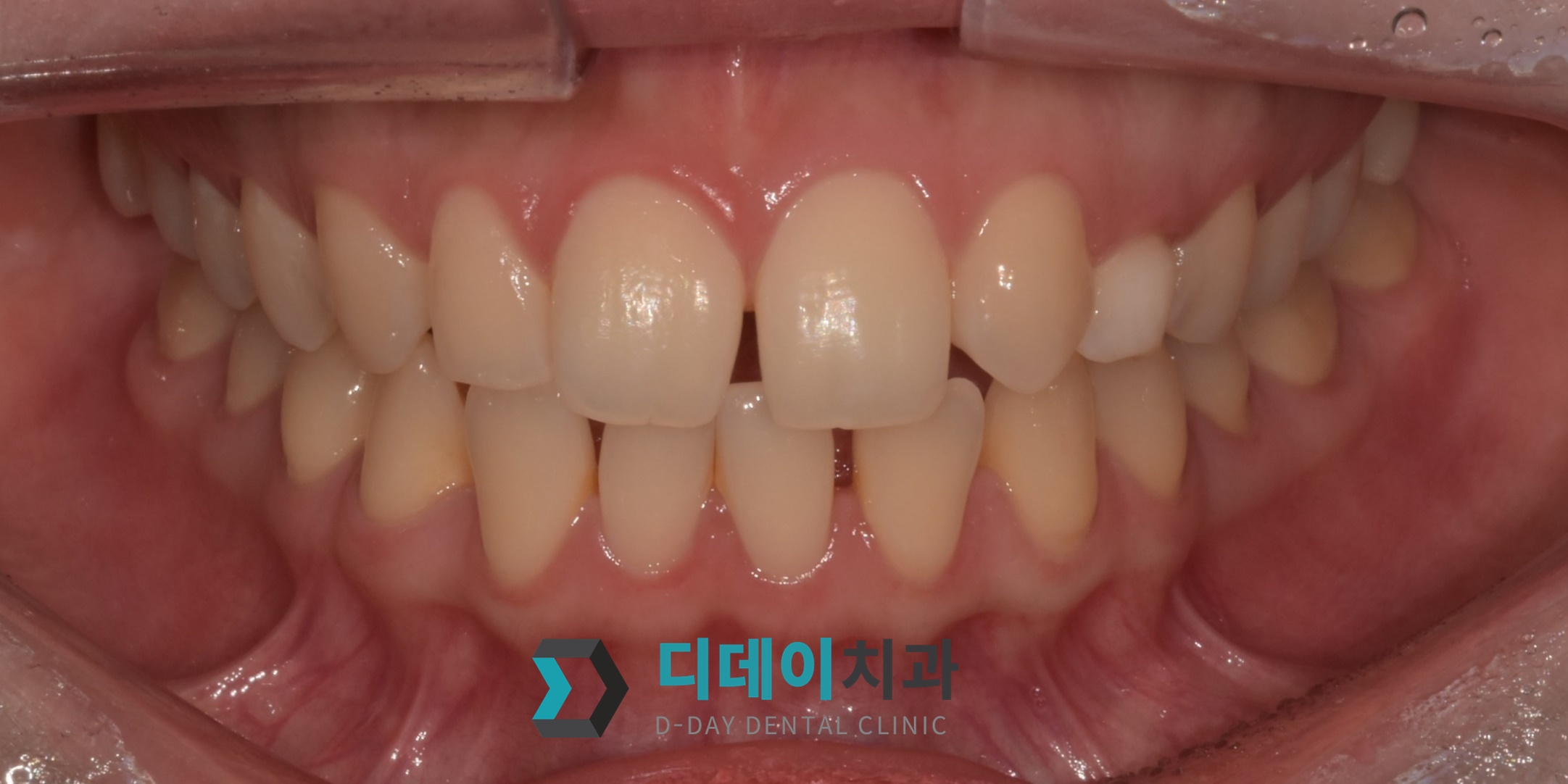 라미네이트 치료 전