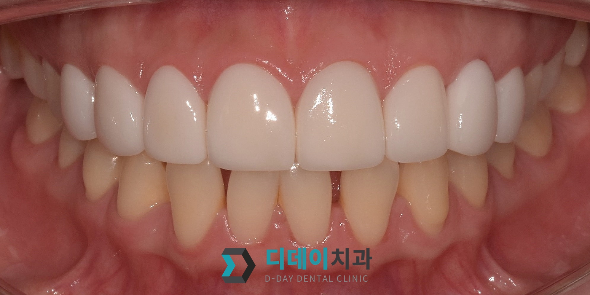라미네이트 치료 후