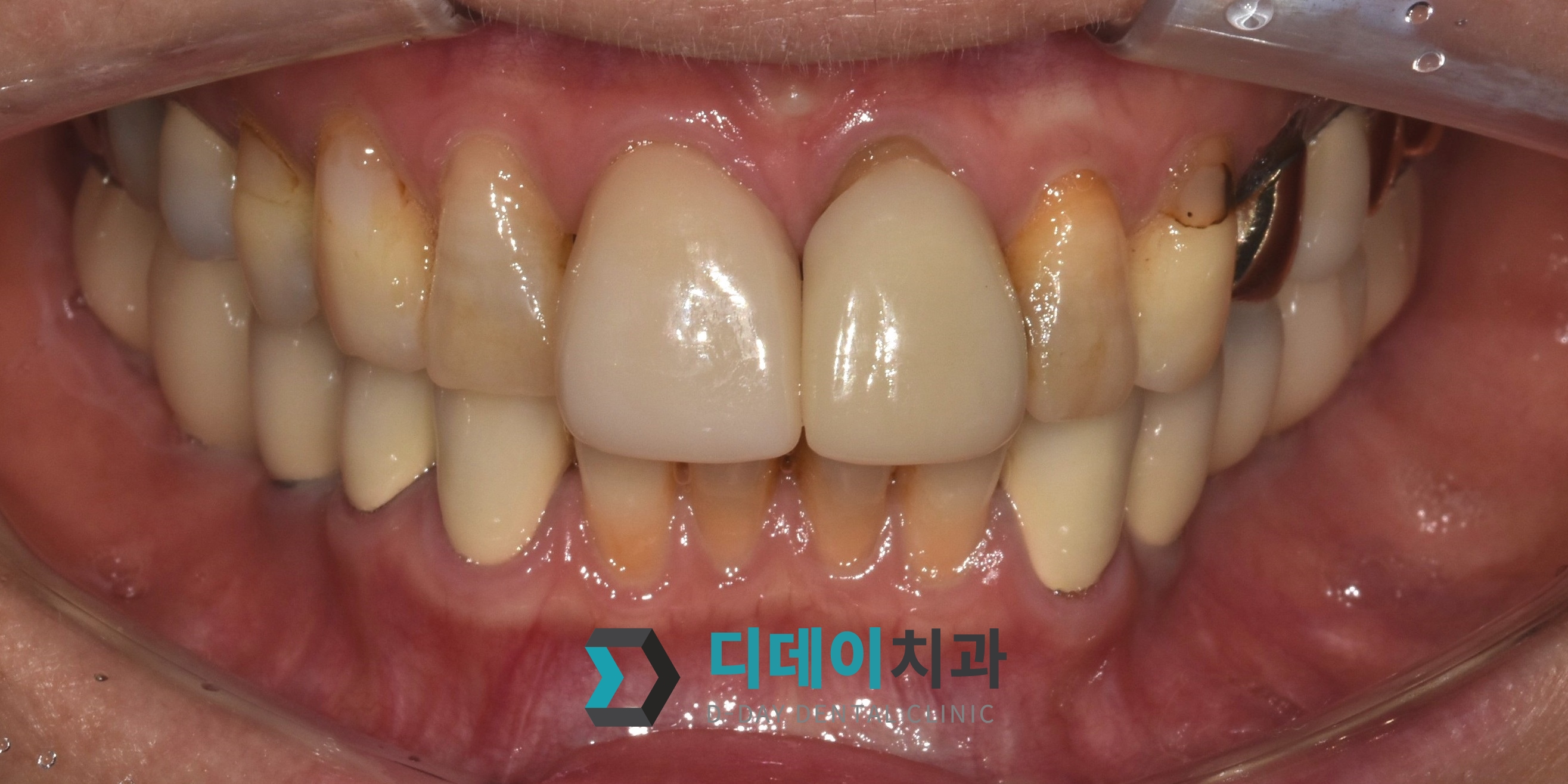 크라운 교체 + 라미네이트 치료 전