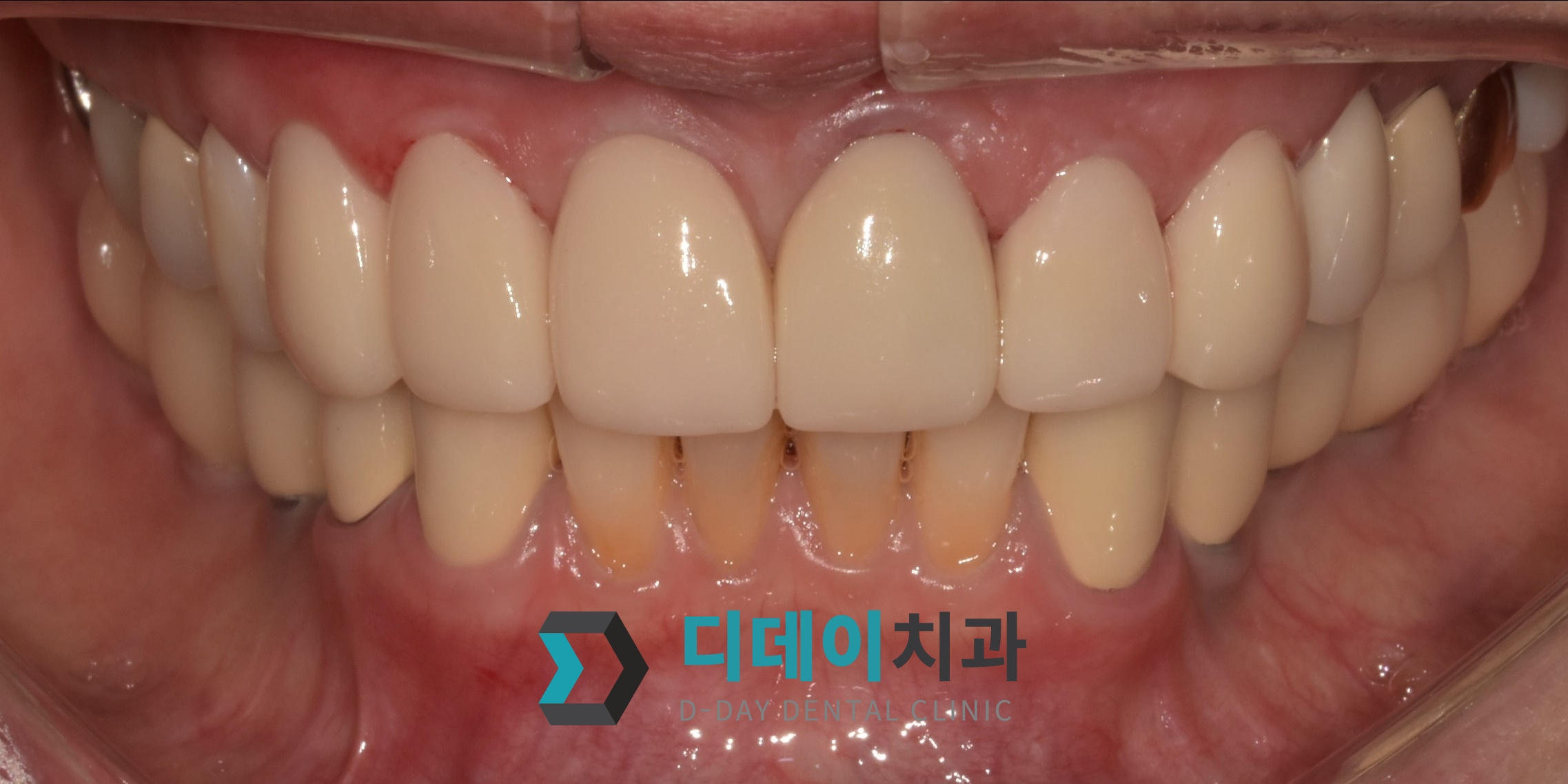 크라운 교체 + 라미네이트 치료 후