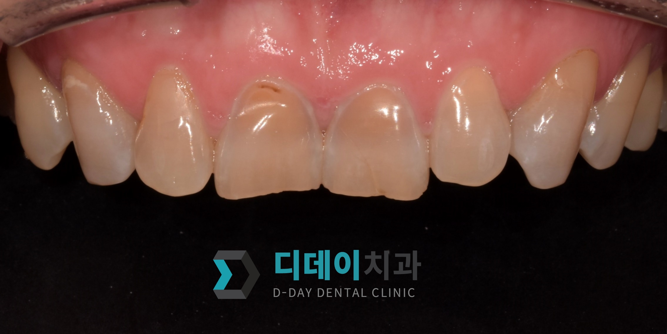 라미네이트 치료 전