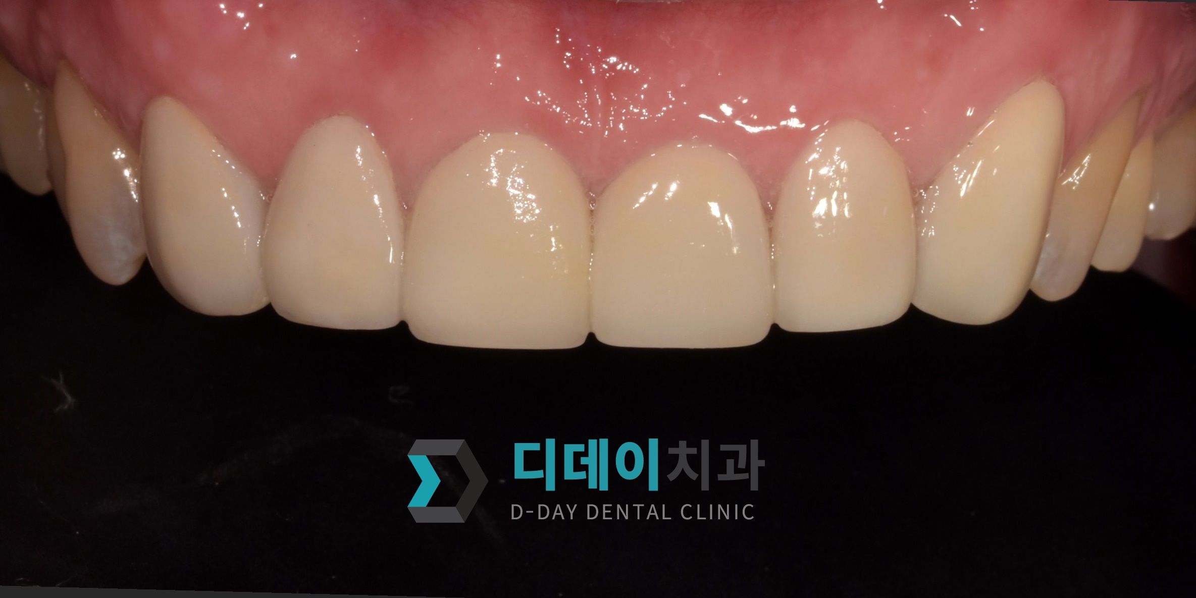 라미네이트 치료 후